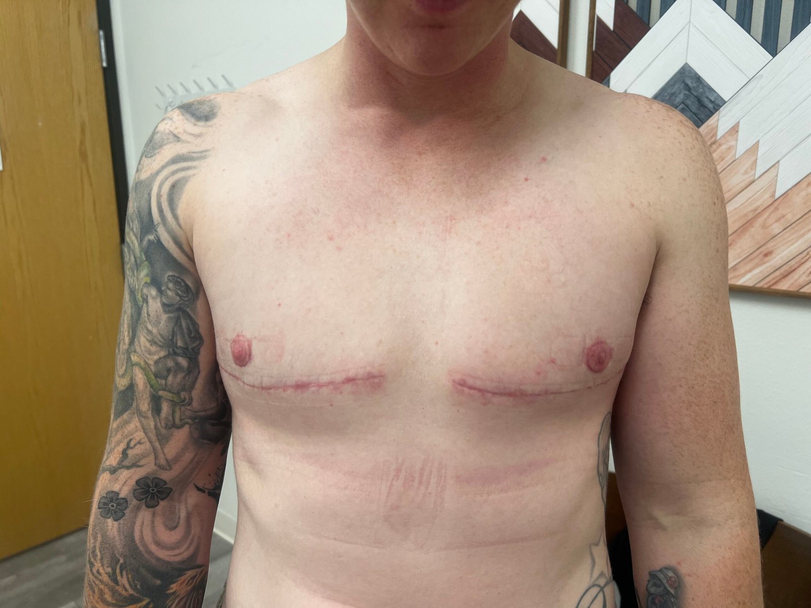 Gender-Affirming Breast Reduction After
