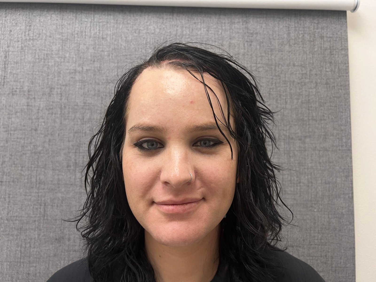 Facial Feminization Surgery After
