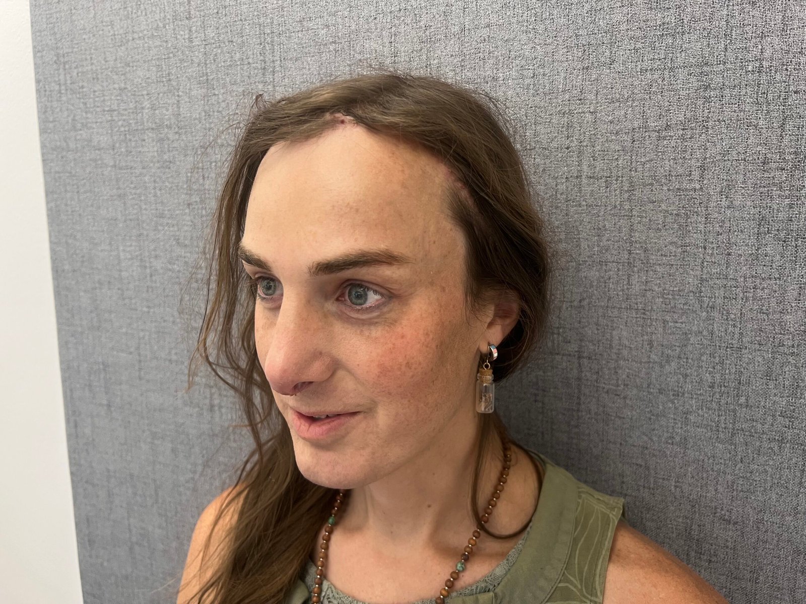 Facial Feminization Surgery After