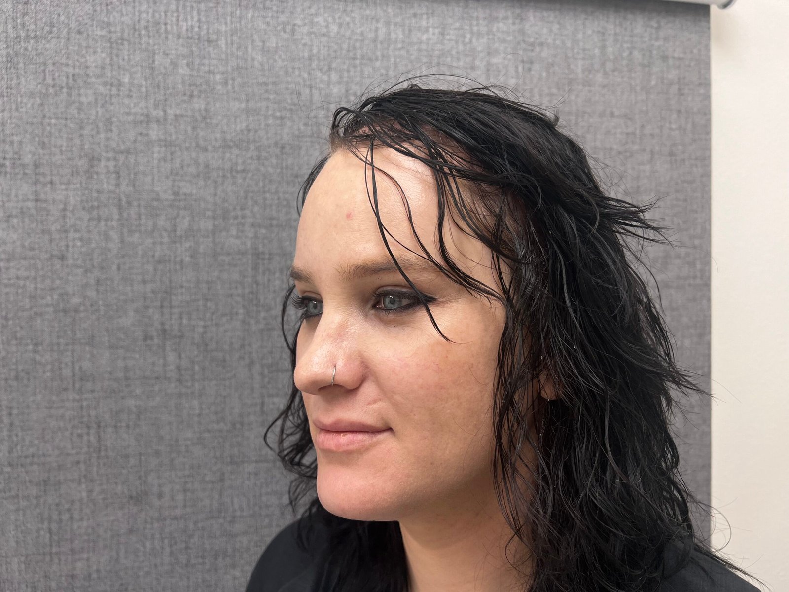 Facial Feminization Surgery After