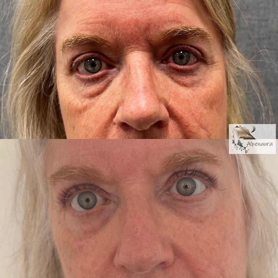 Upper Blepharoplasty