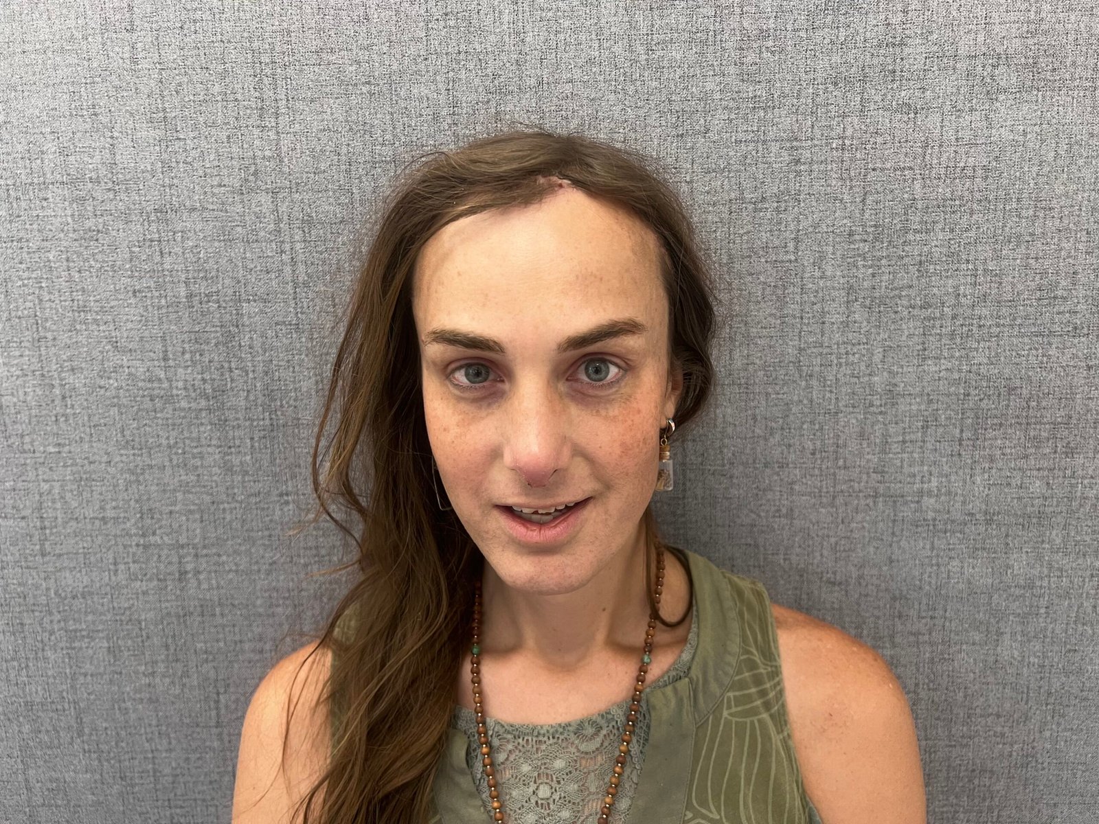 Facial Feminization Surgery After
