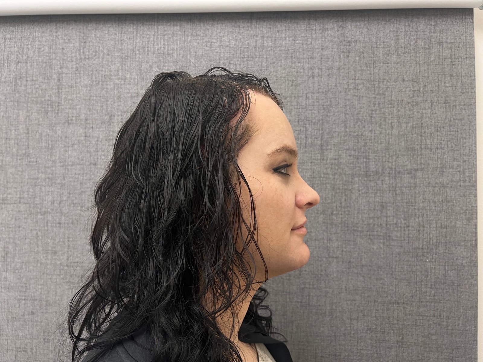 Facial Feminization Surgery After