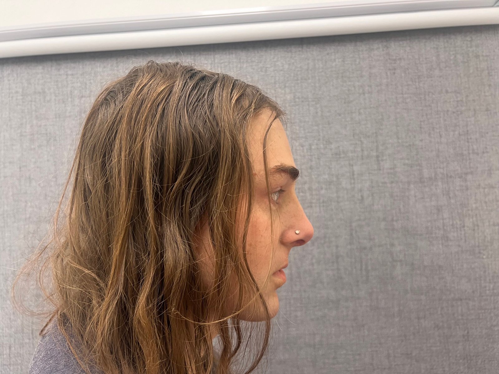 Facial Feminization Surgery After