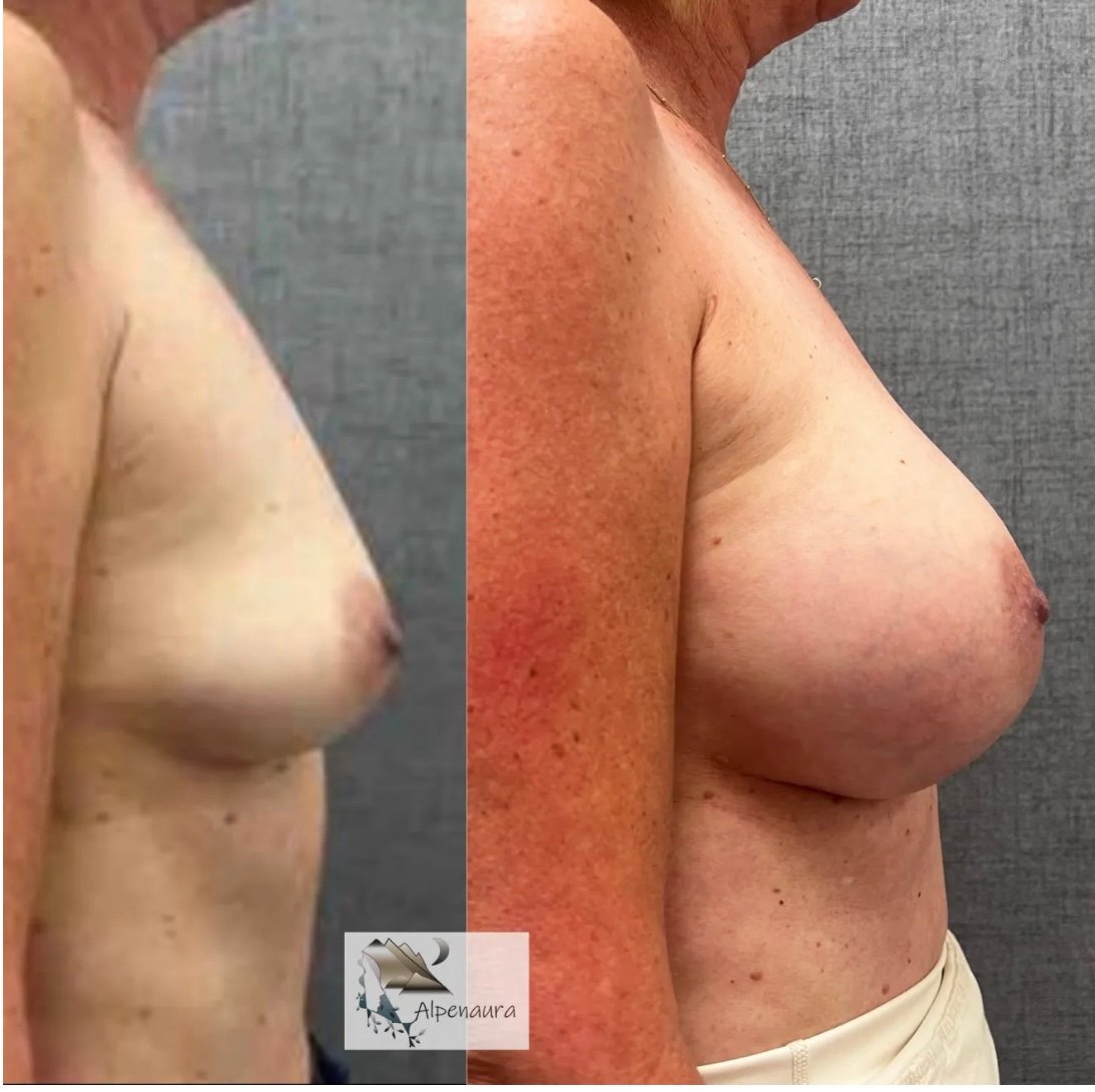 Breast Augmentation