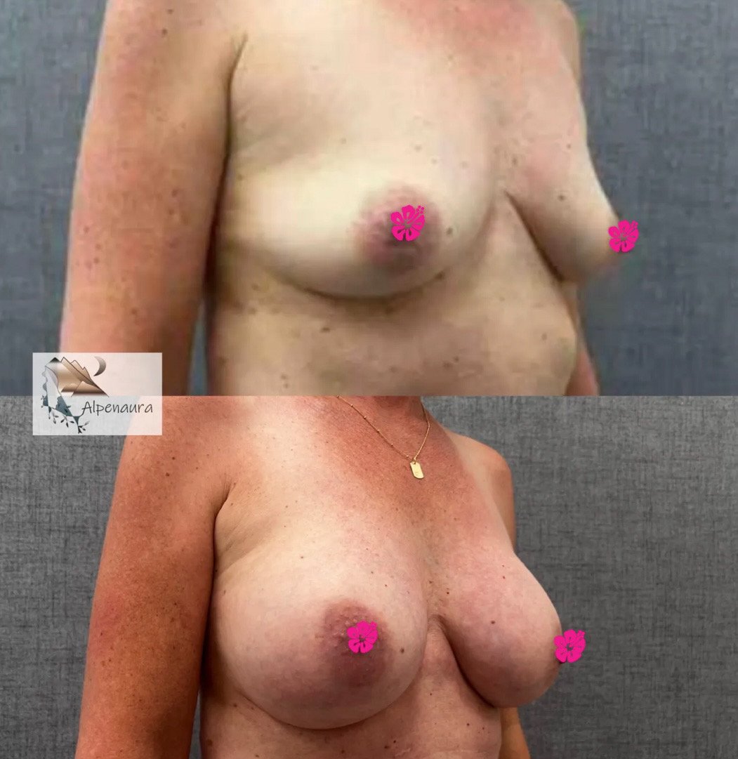 Breast Augmentation
