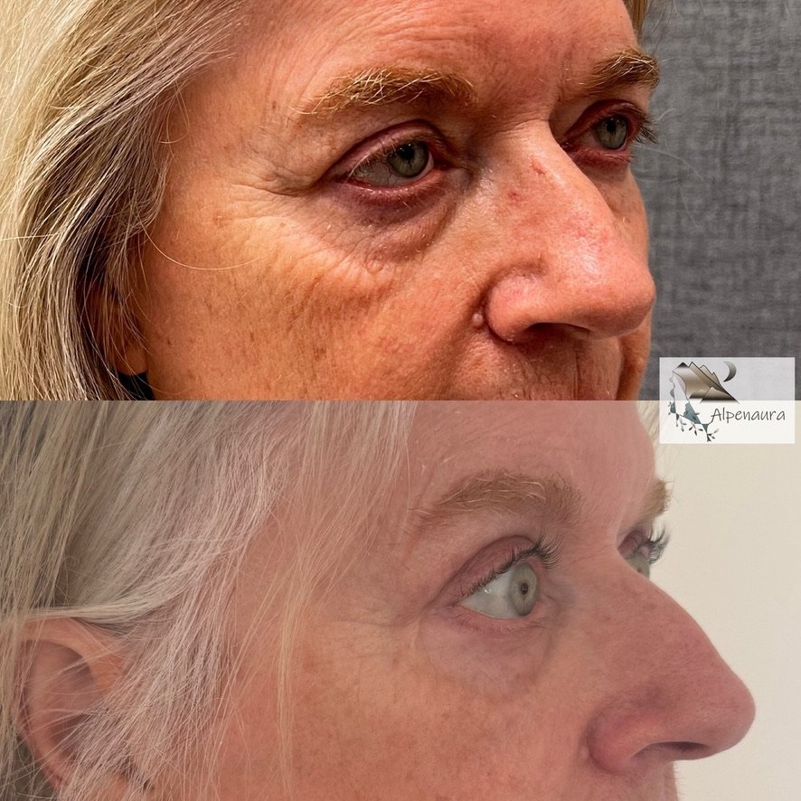 Upper Blepharoplasty