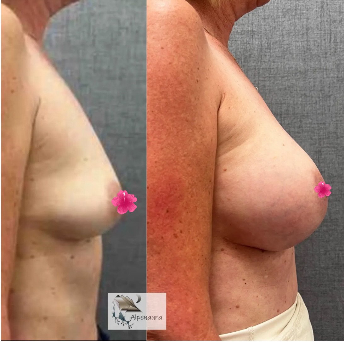 Breast Augmentation