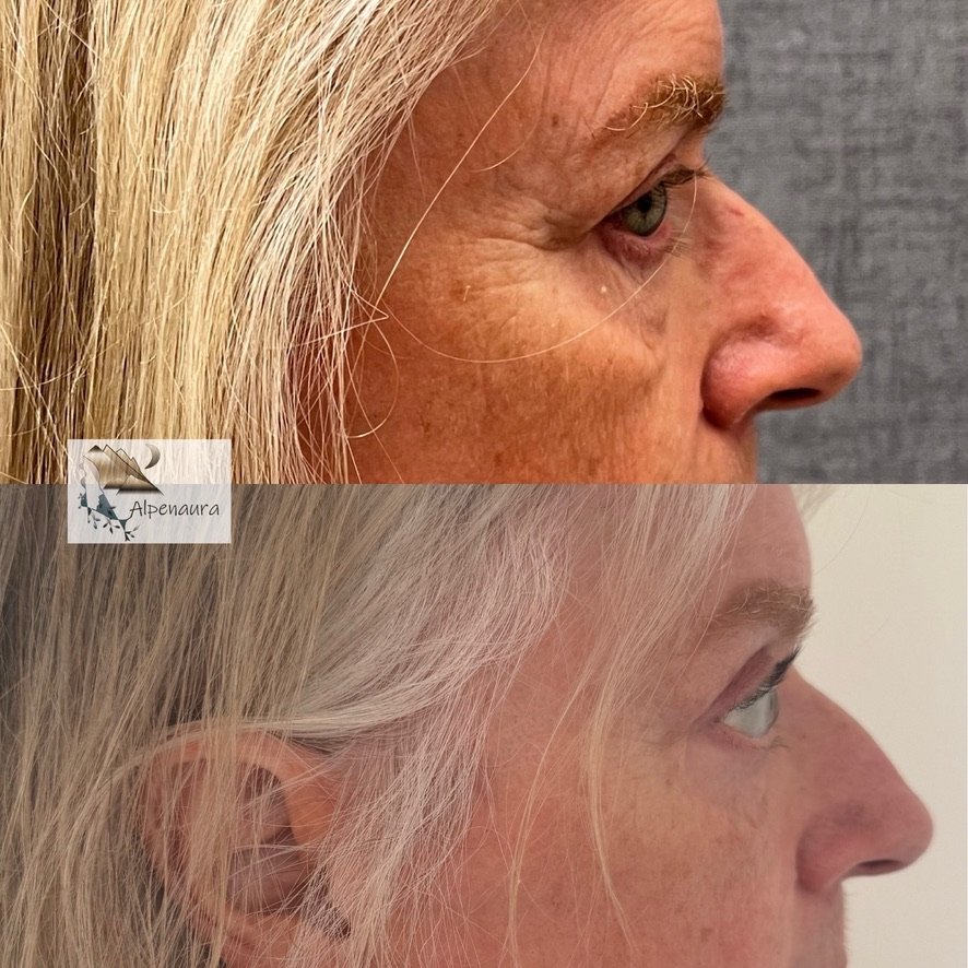 Upper Blepharoplasty