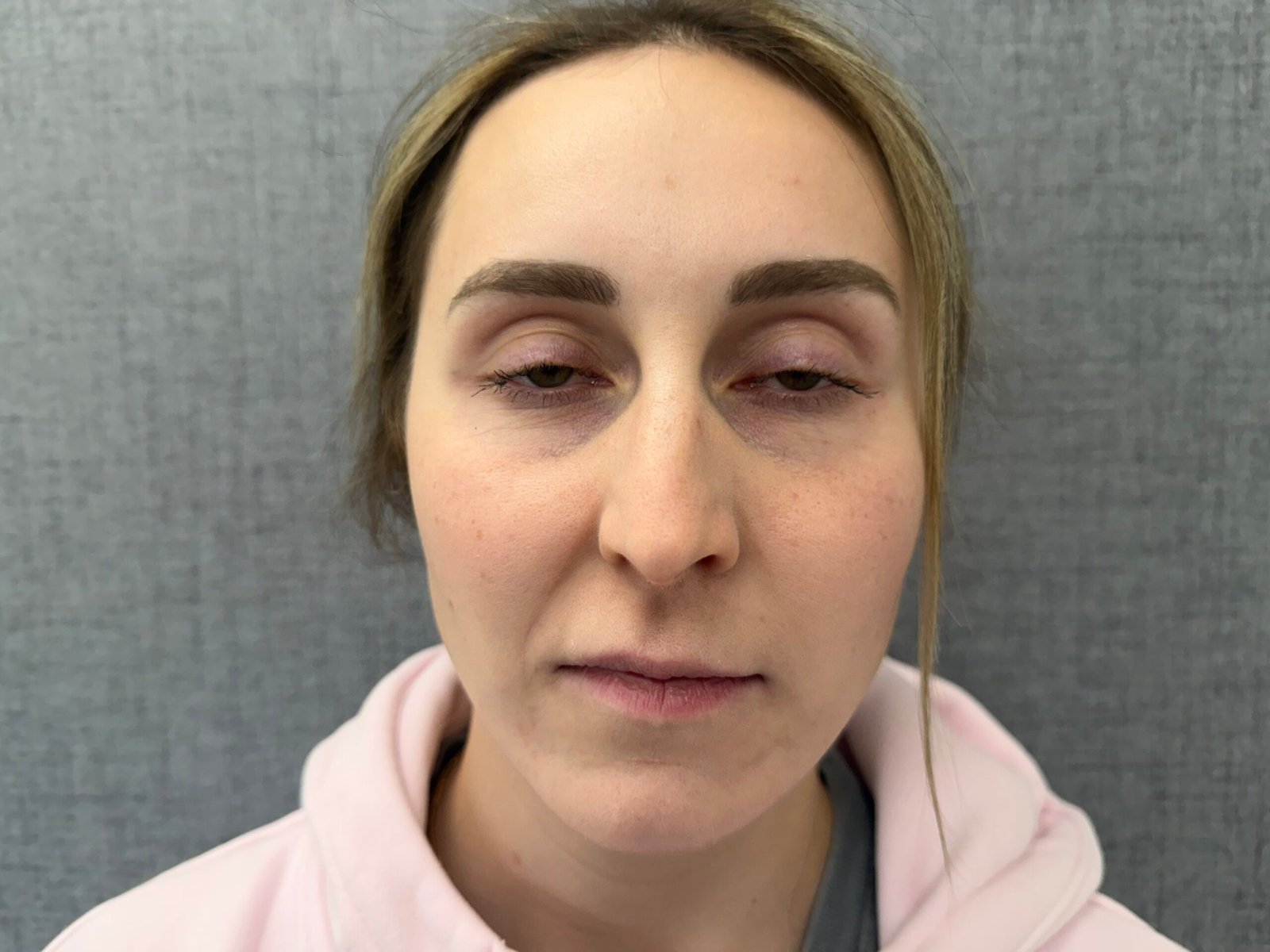 Lip Lift Before
