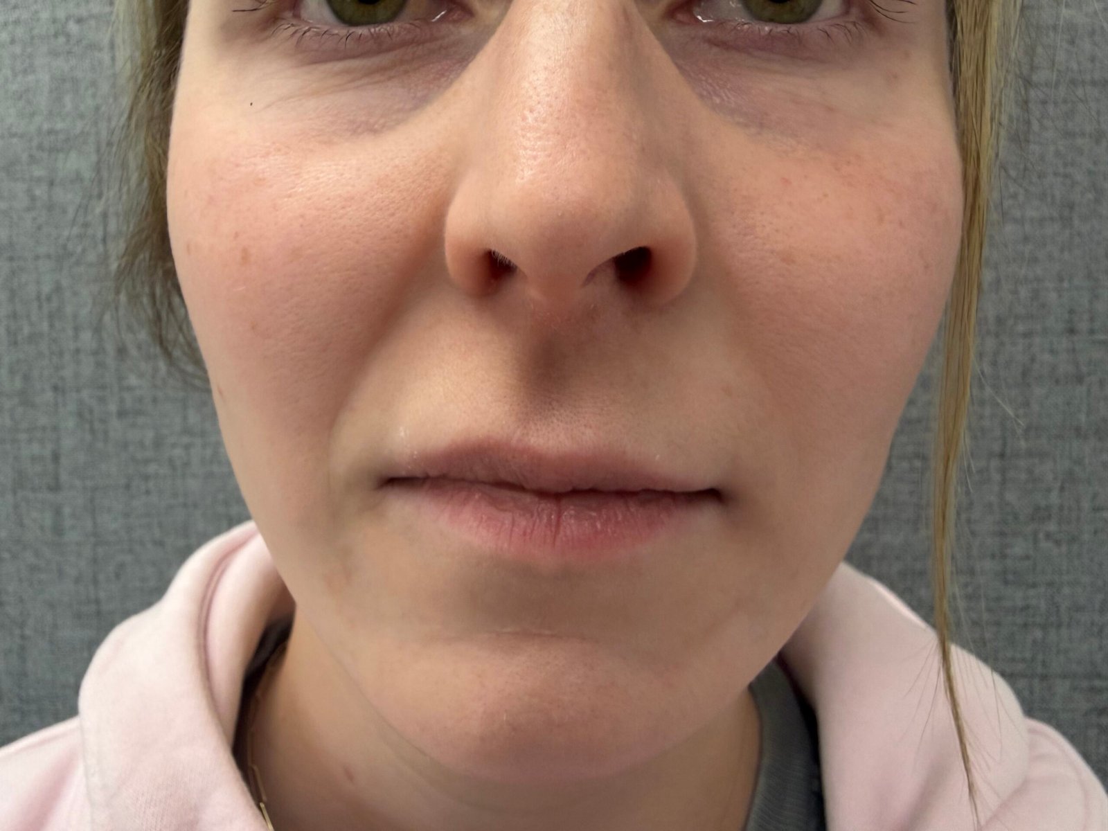 Lip Lift Before