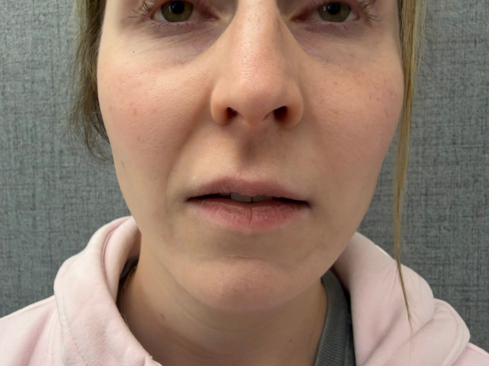Lip Lift Before