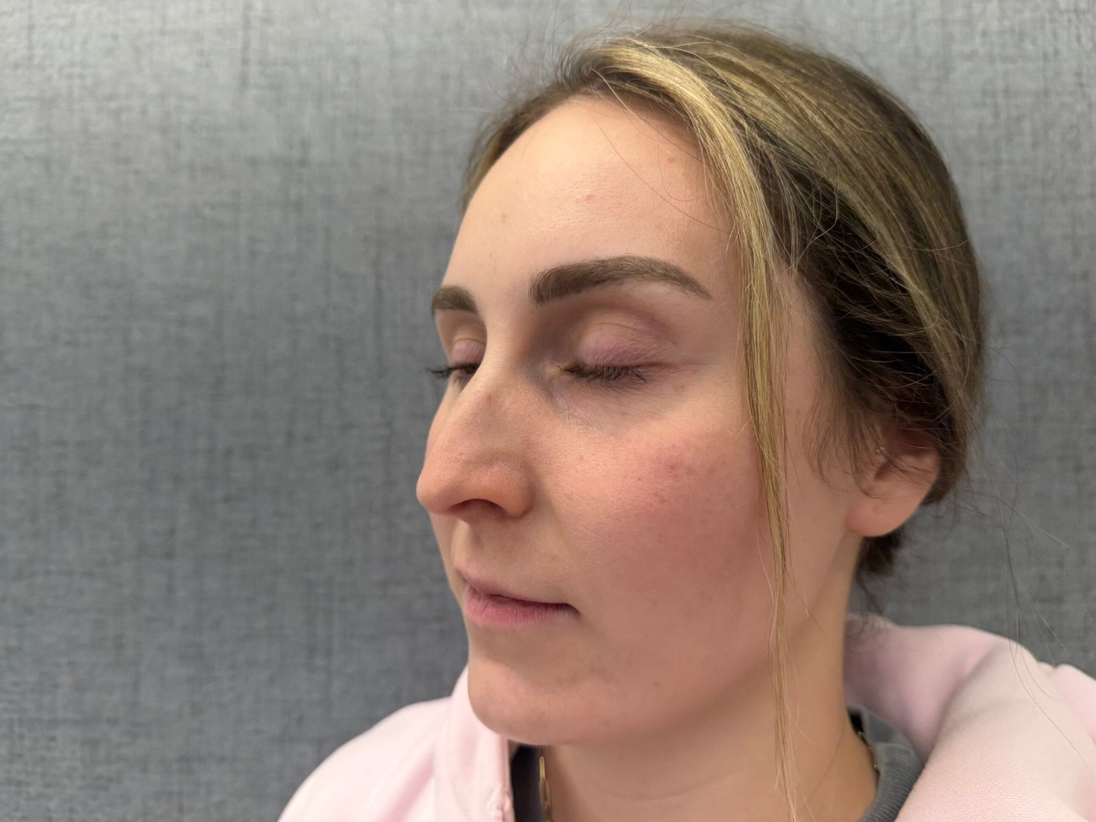 Lip Lift Before
