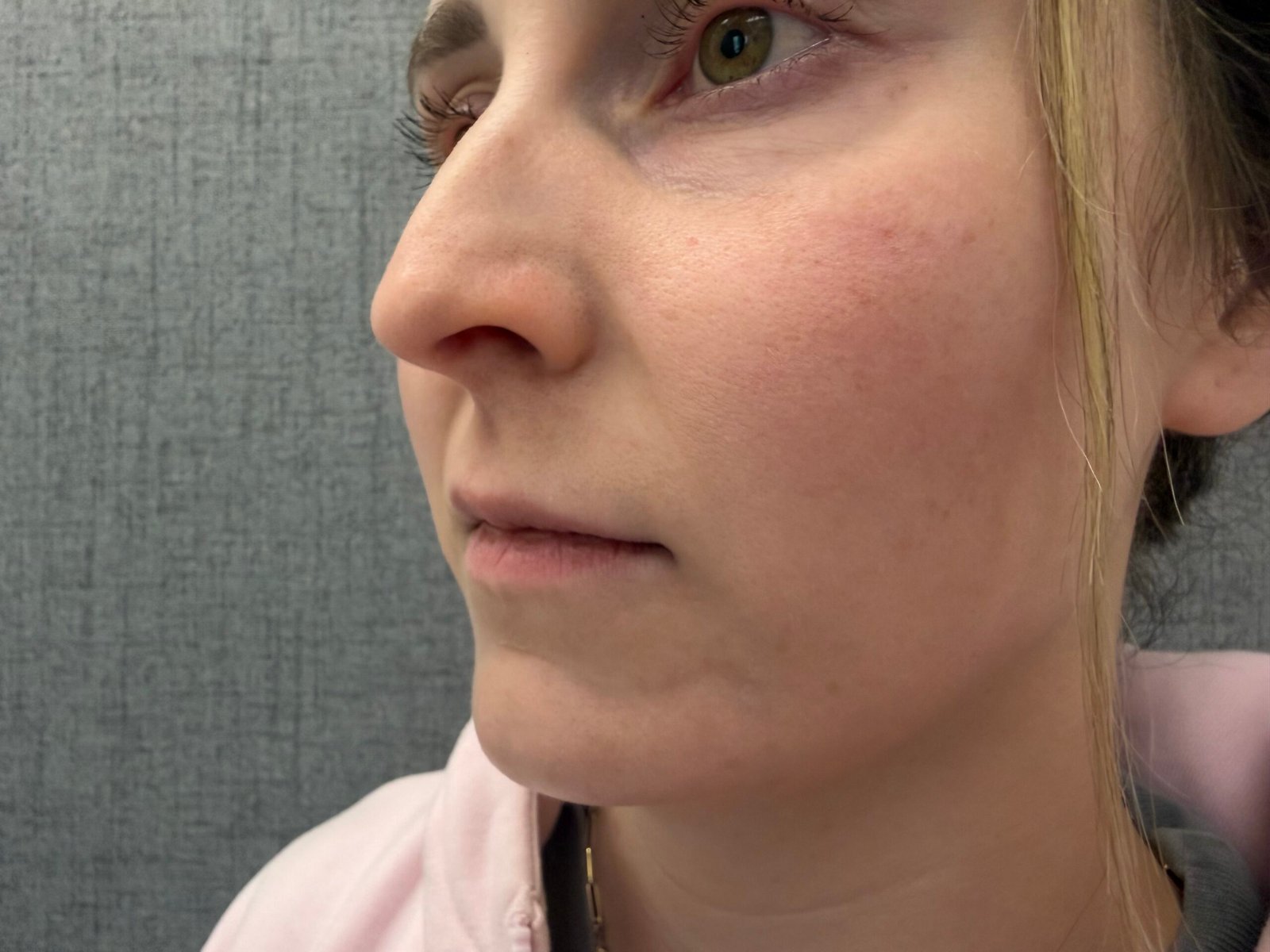 Lip Lift Before