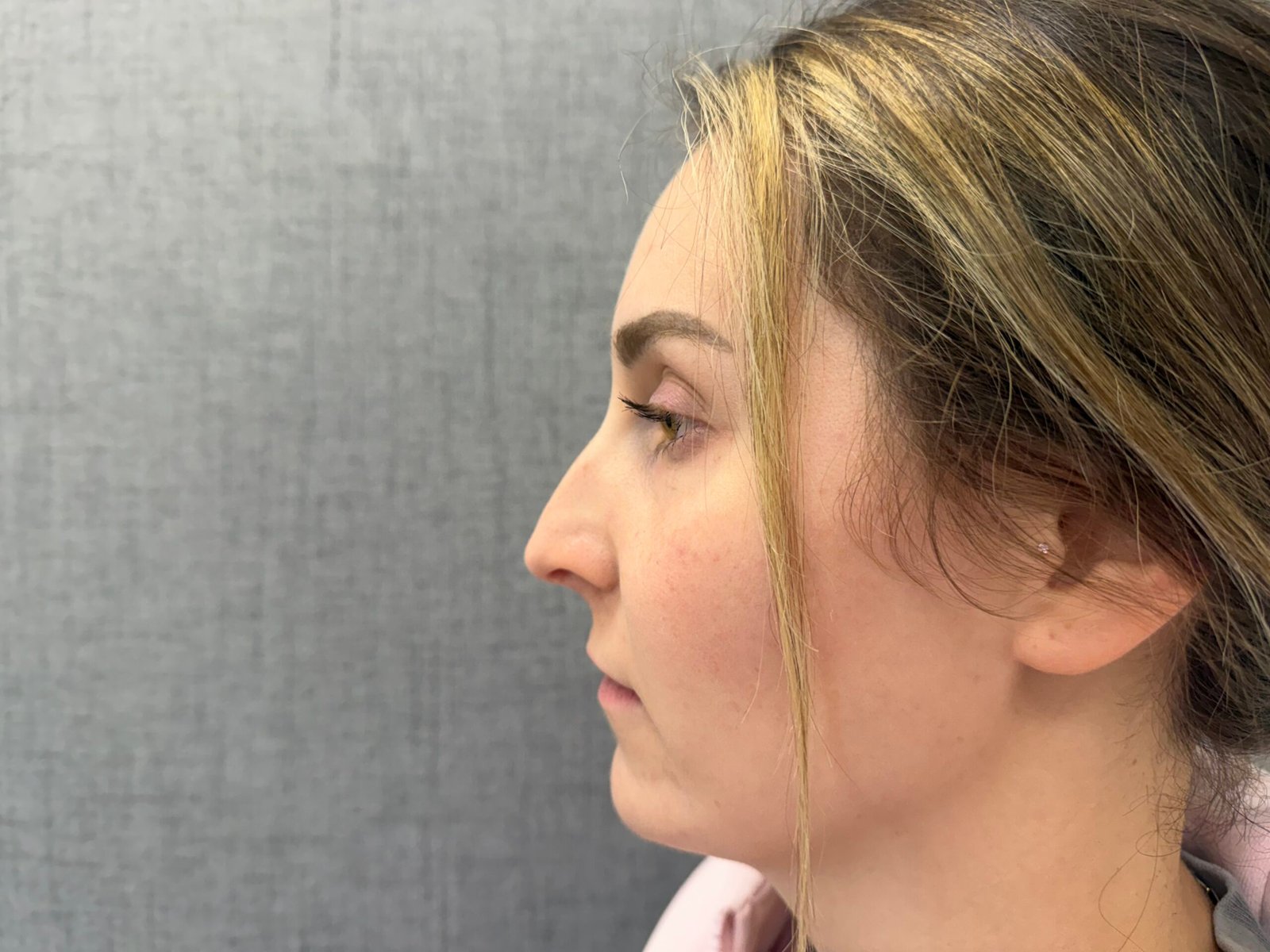 Lip Lift Before