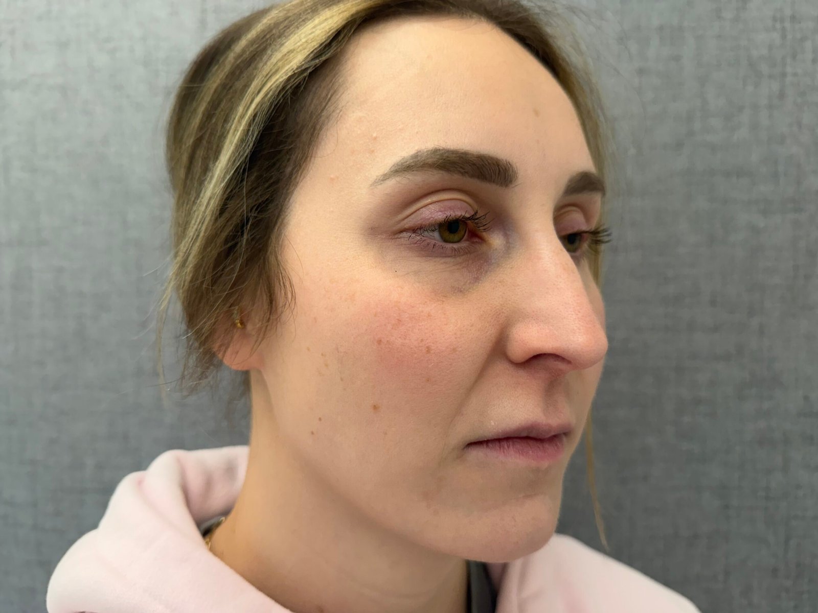 Lip Lift Before