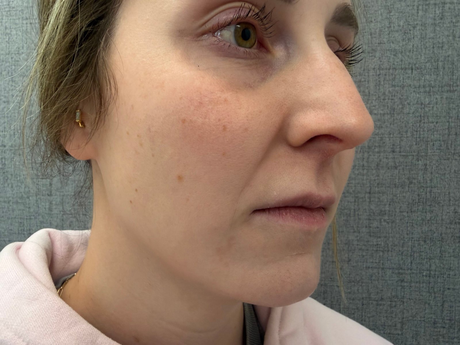Lip Lift Before