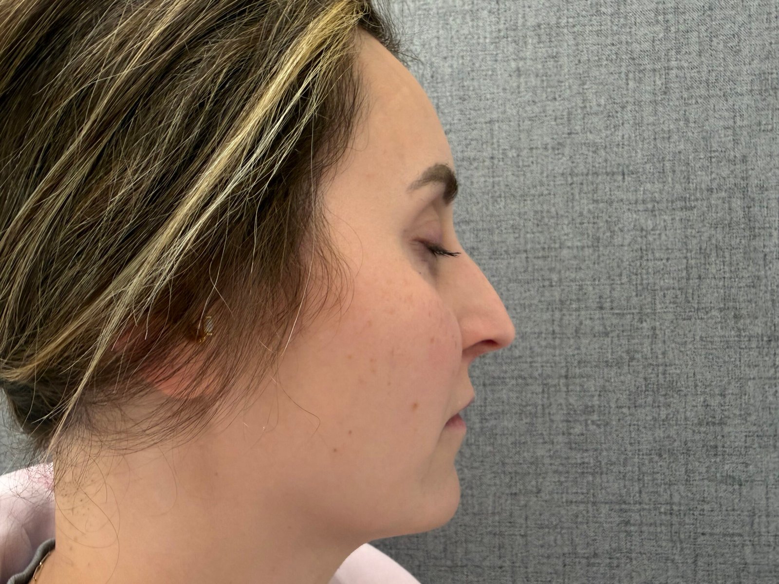 Lip Lift Before