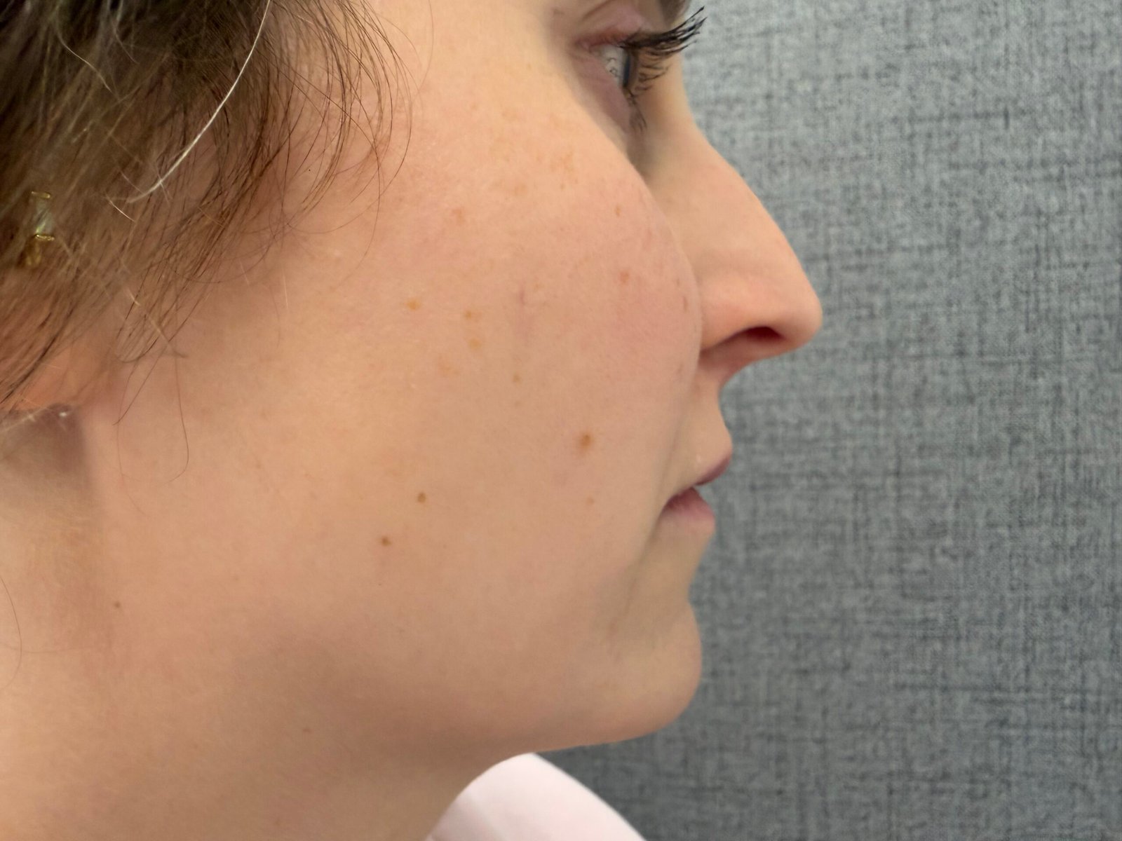 Lip Lift Before