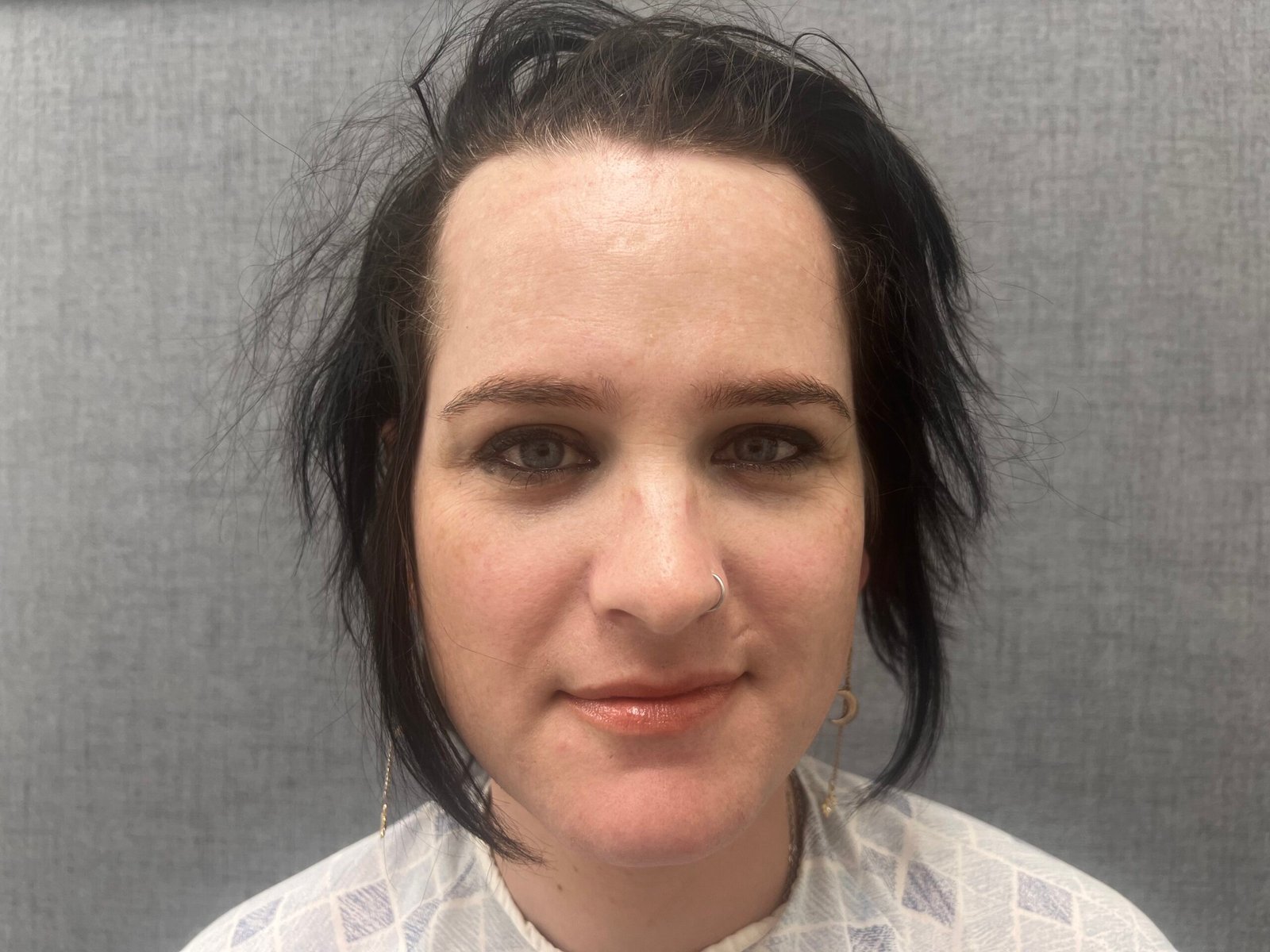 Facial Feminization Surgery Before