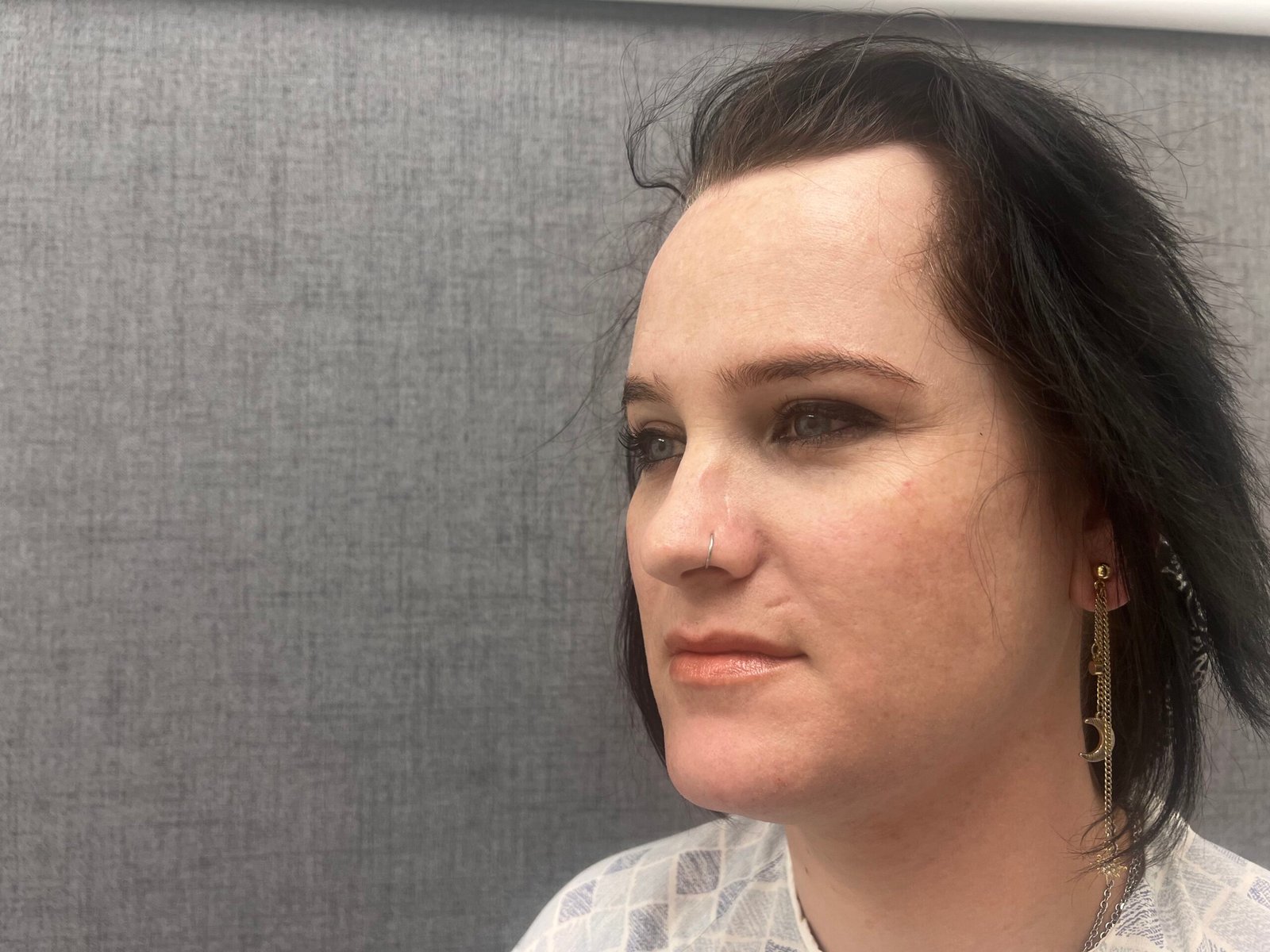Facial Feminization Surgery Before