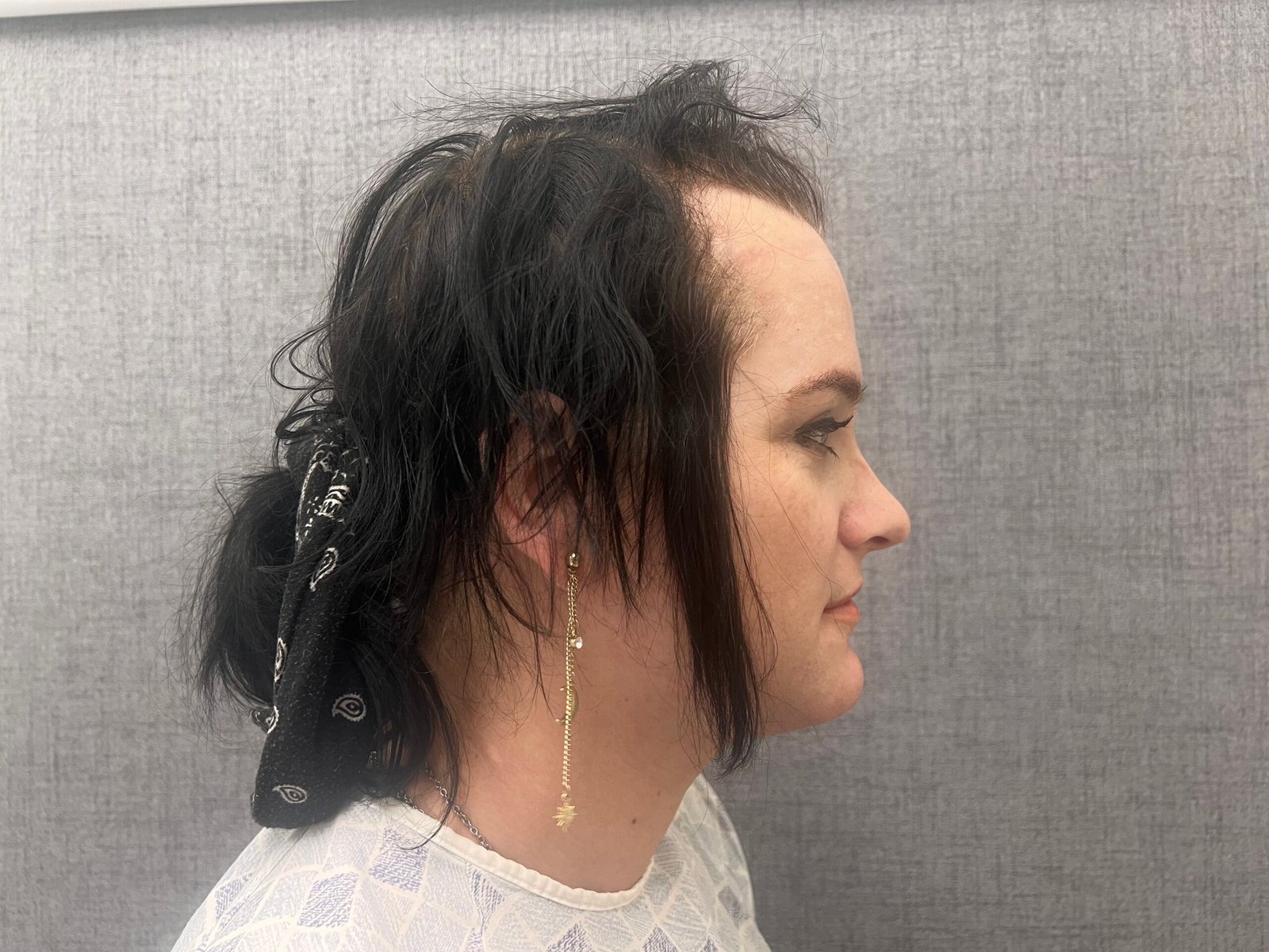Facial Feminization Surgery Before