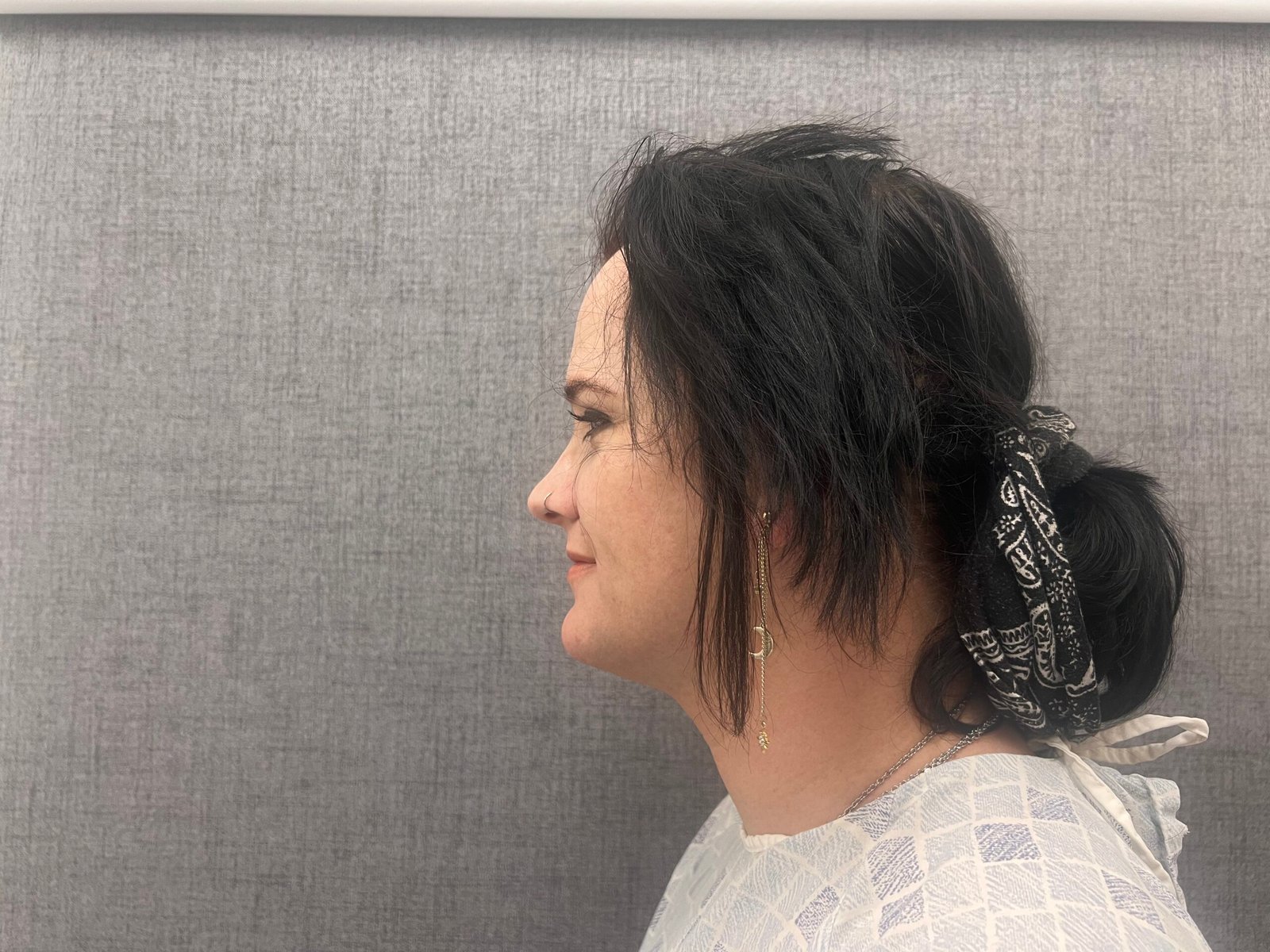 Facial Feminization Surgery Before