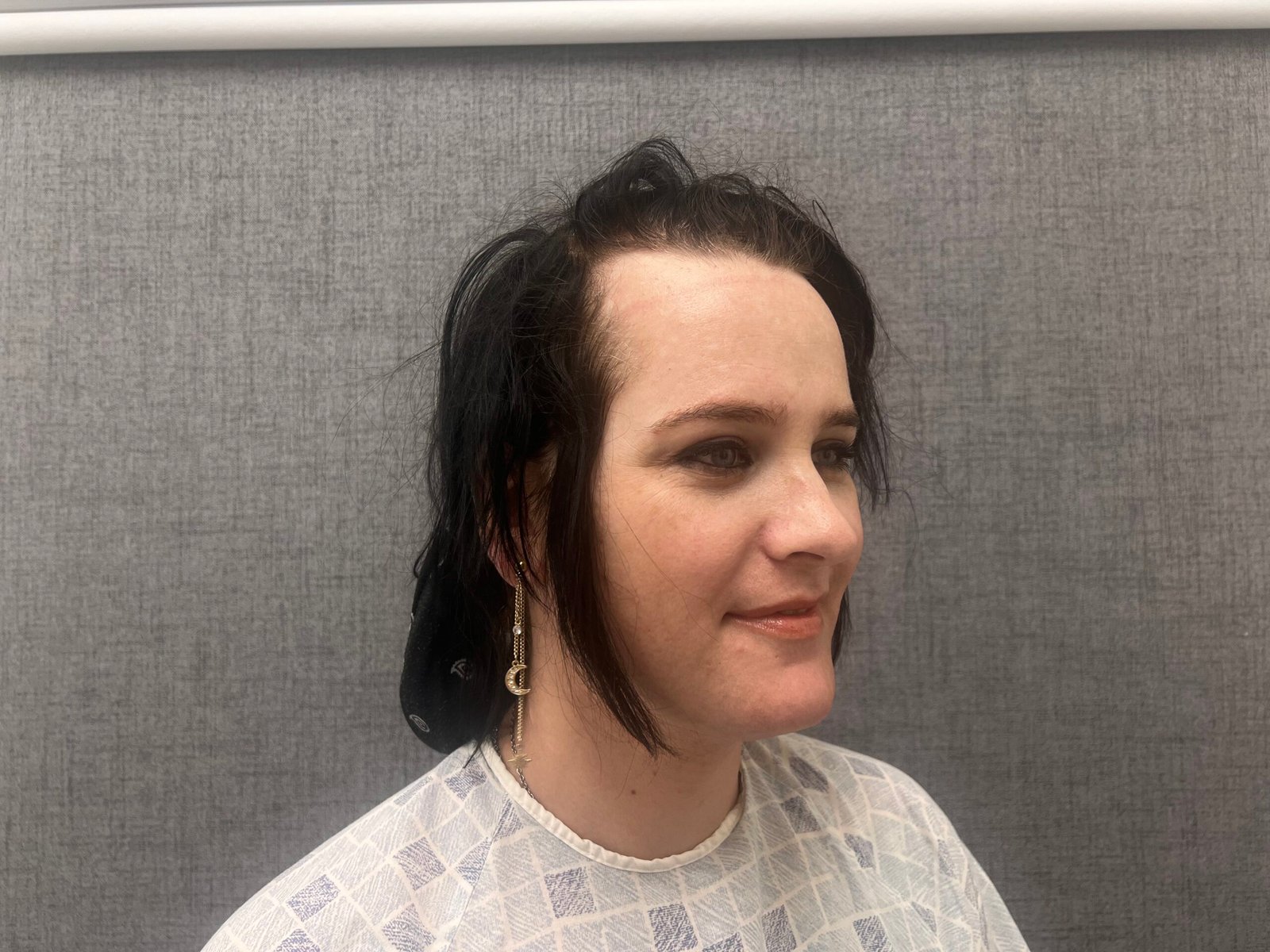Facial Feminization Surgery Before
