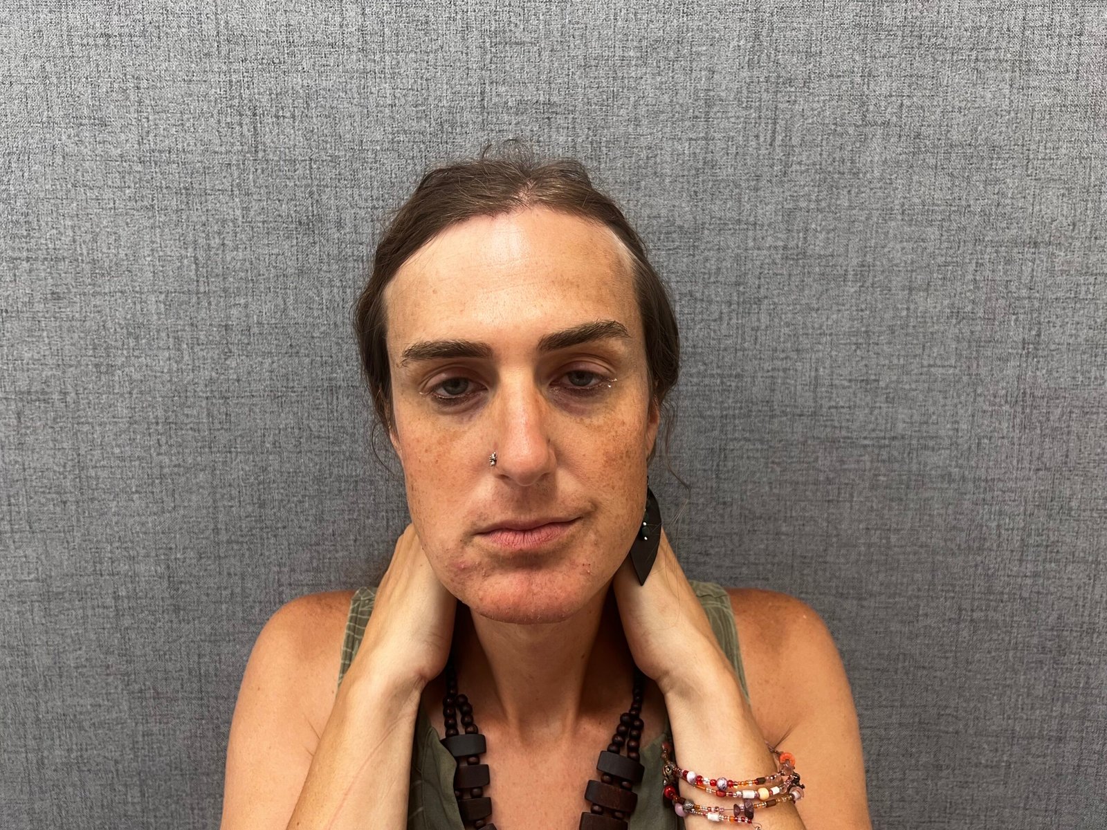 Facial Feminization Surgery Before