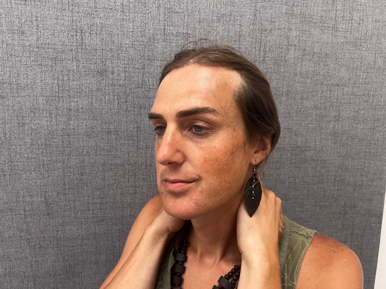 Facial Feminization Surgery Before