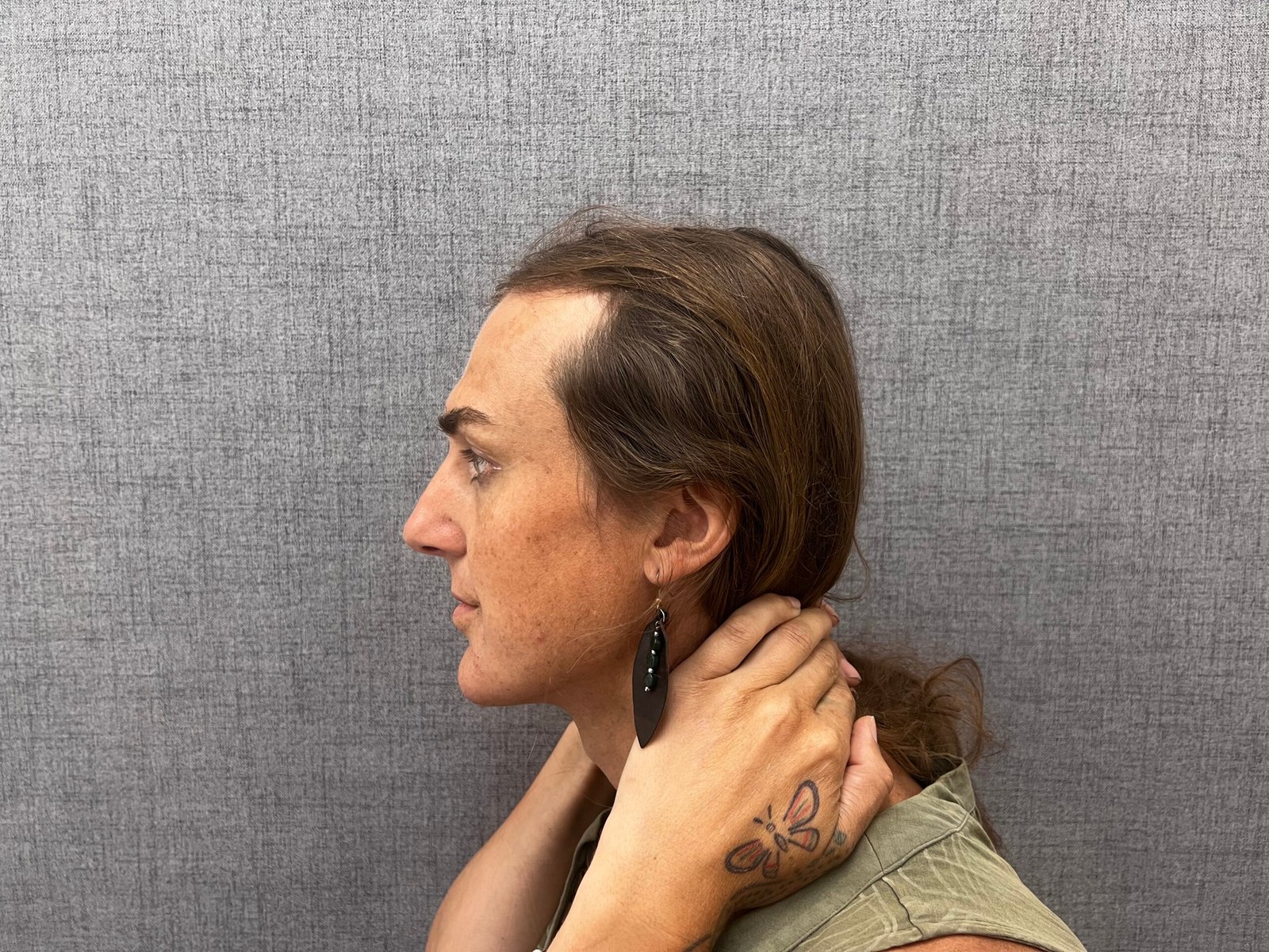 Facial Feminization Surgery Before