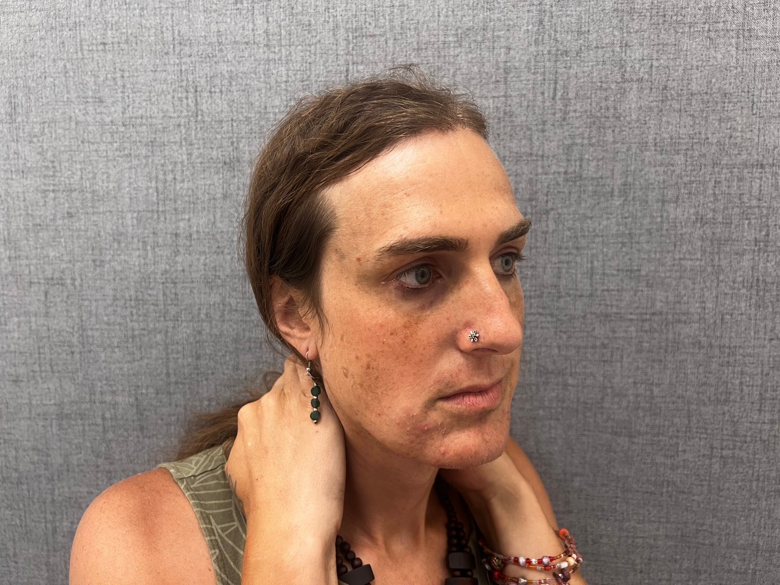 Facial Feminization Surgery Before