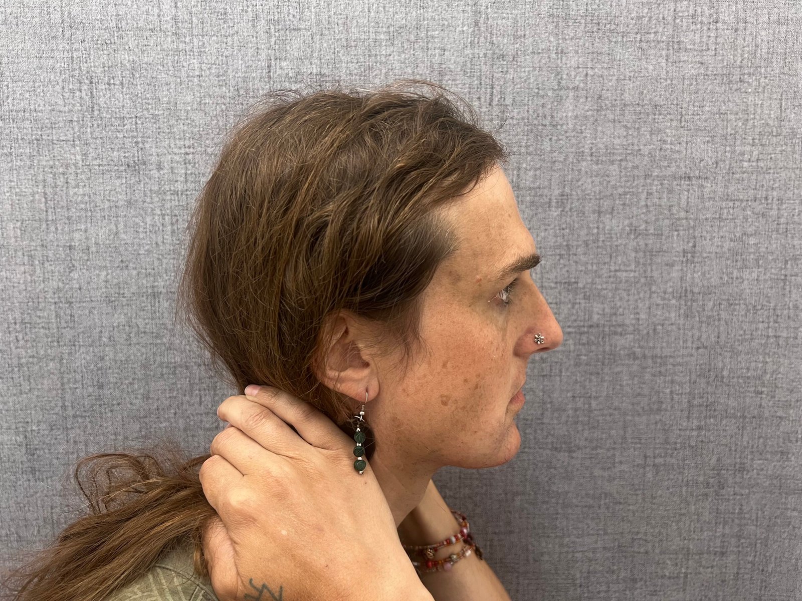 Facial Feminization Surgery Before