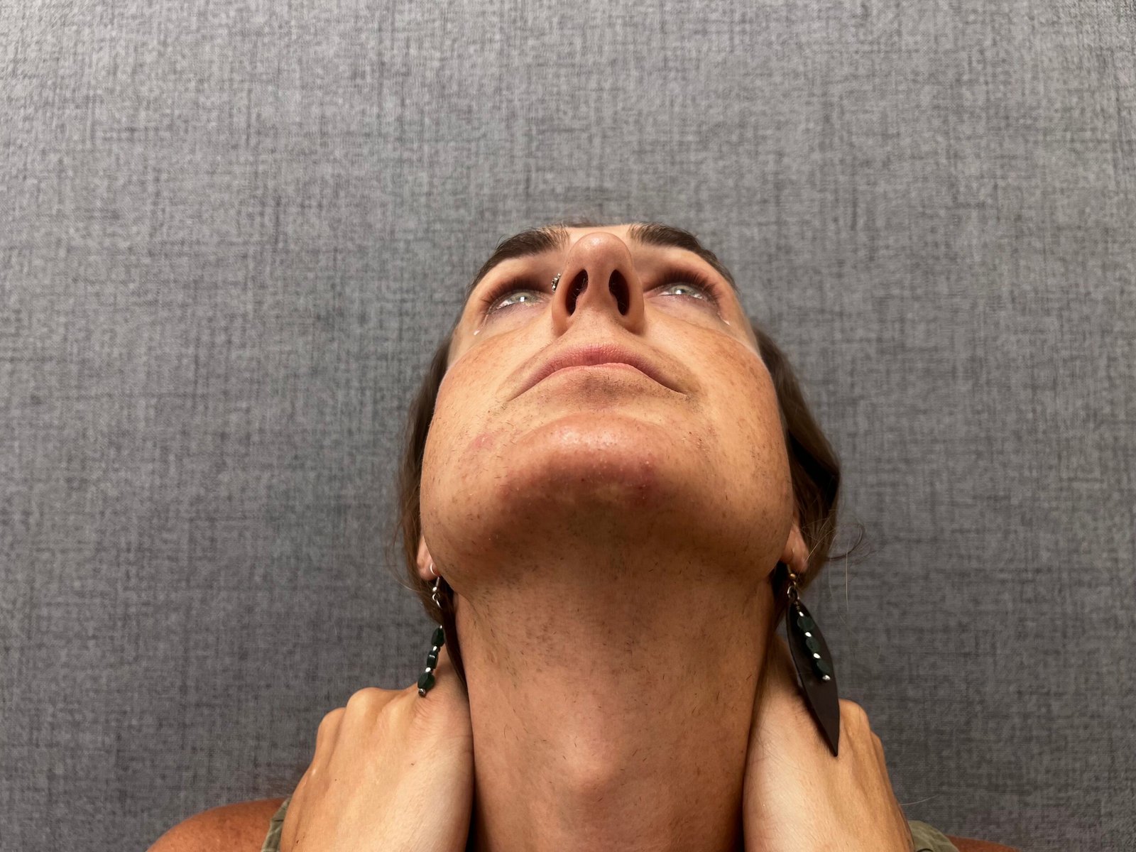 Facial Feminization Surgery Before