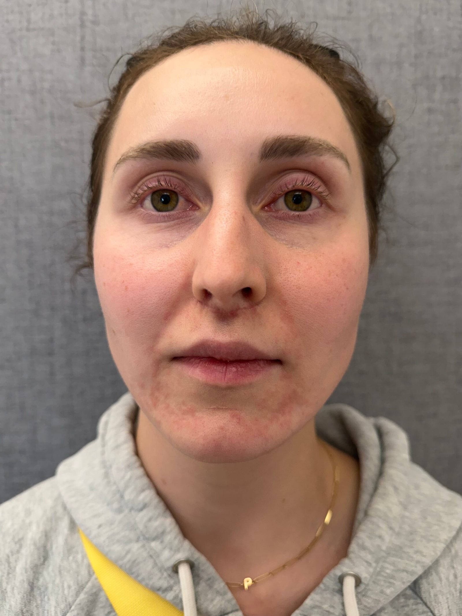 Lip Lift After