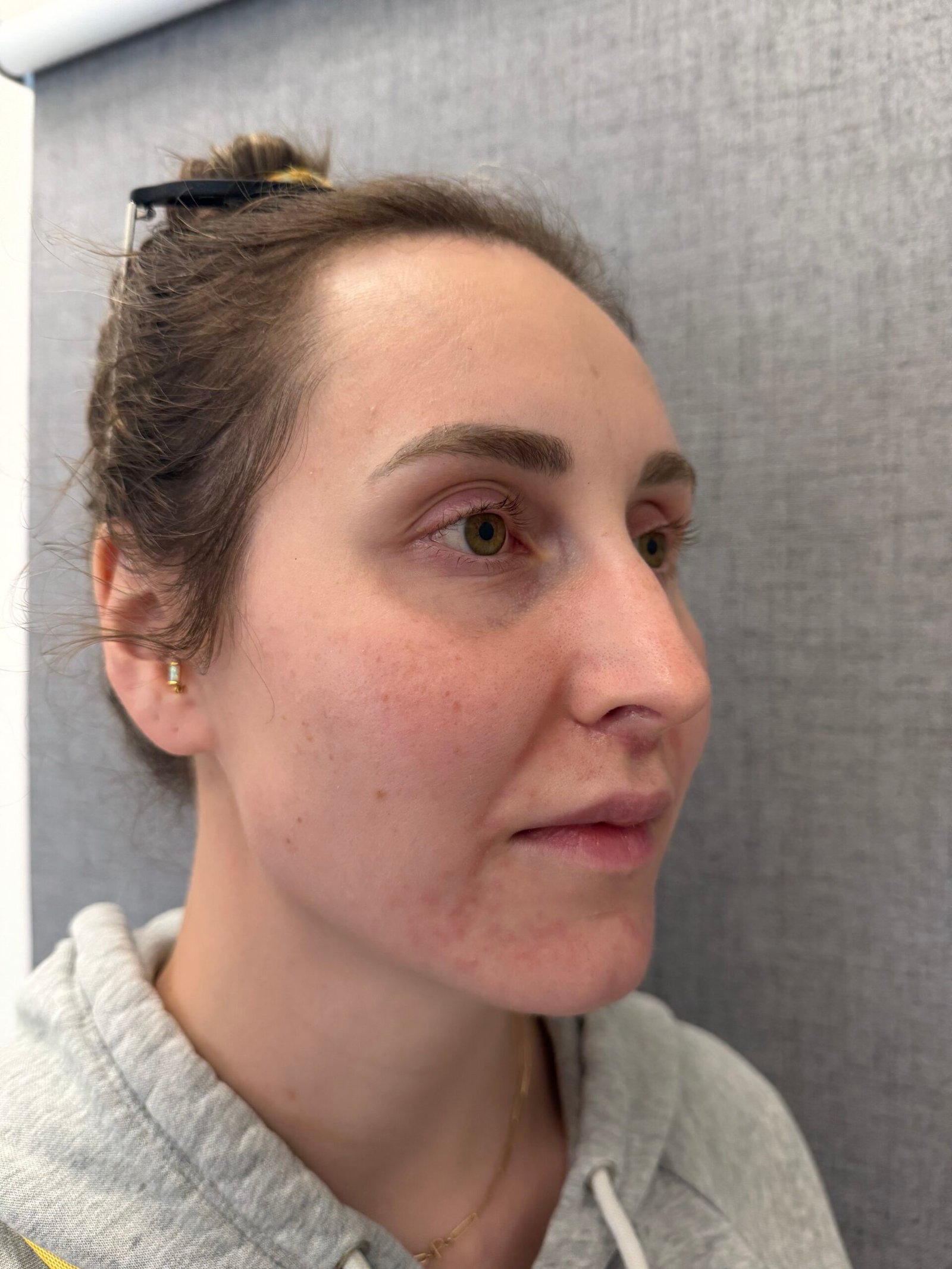 Lip Lift After