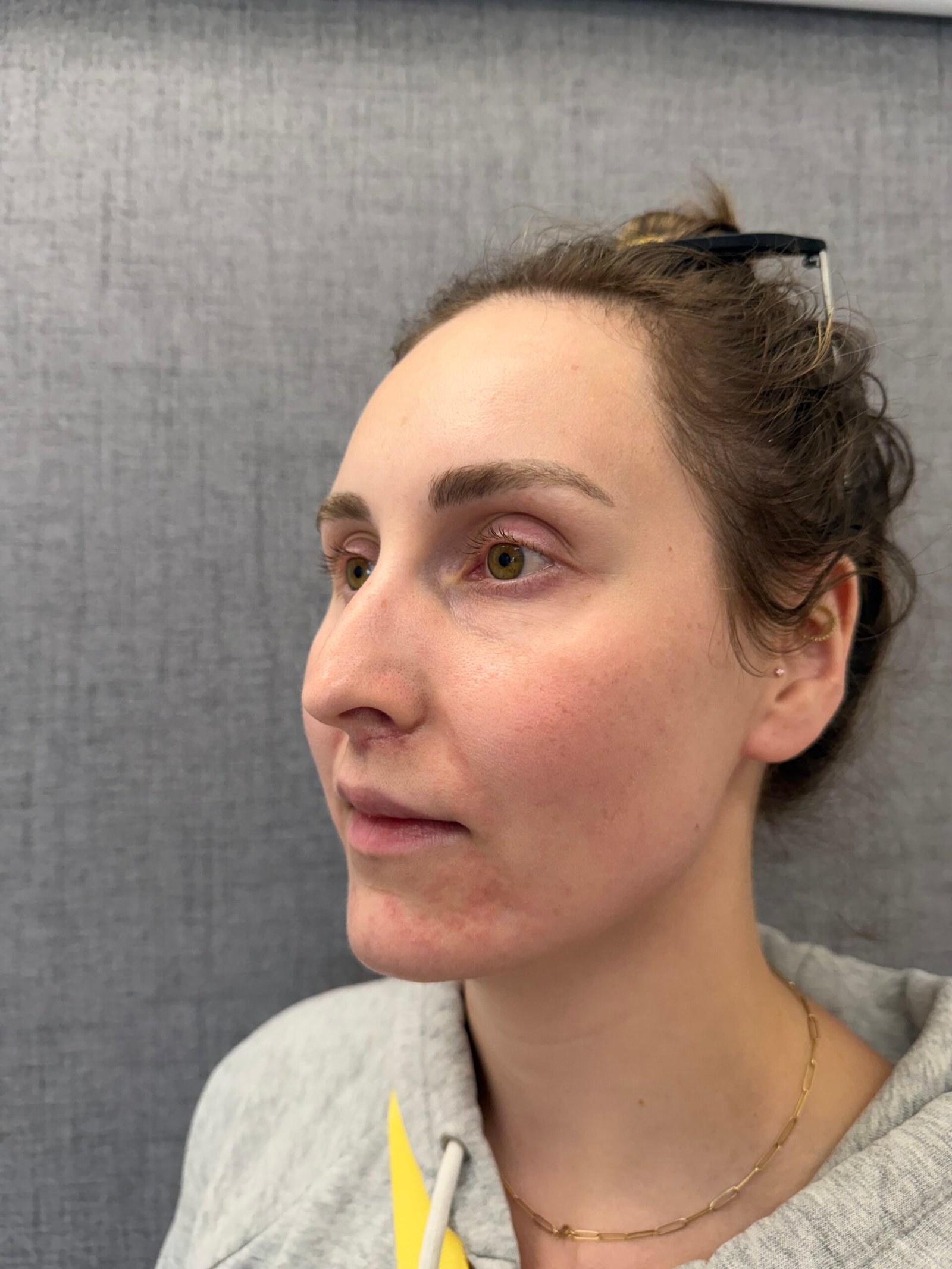 Lip Lift After