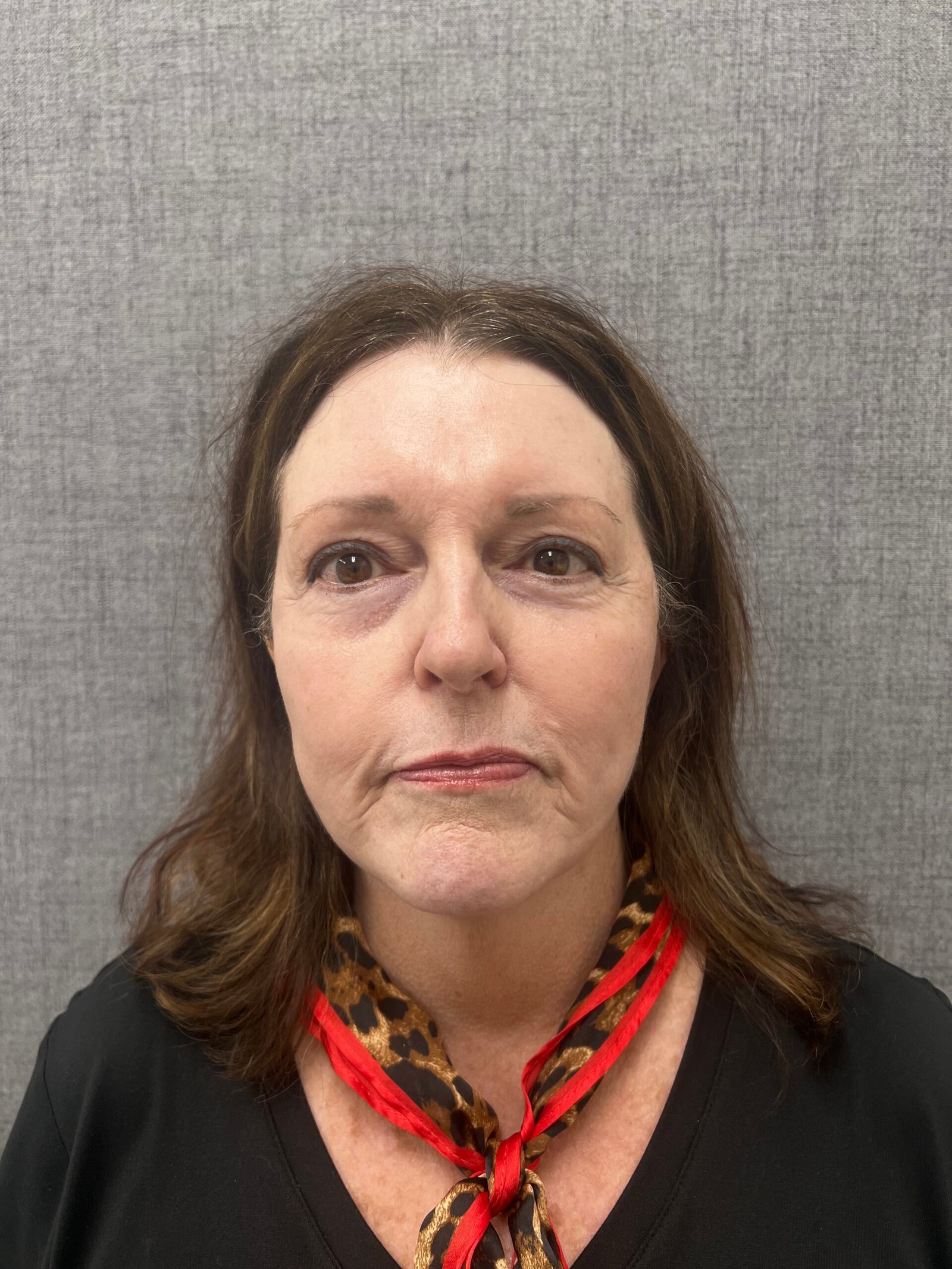 Facelift Surgery Before