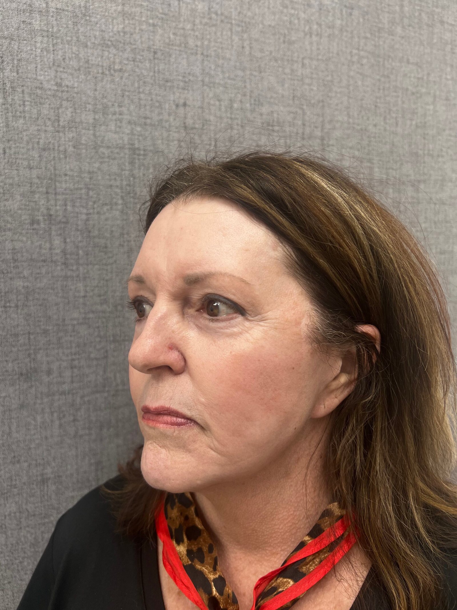 Facelift Surgery Before