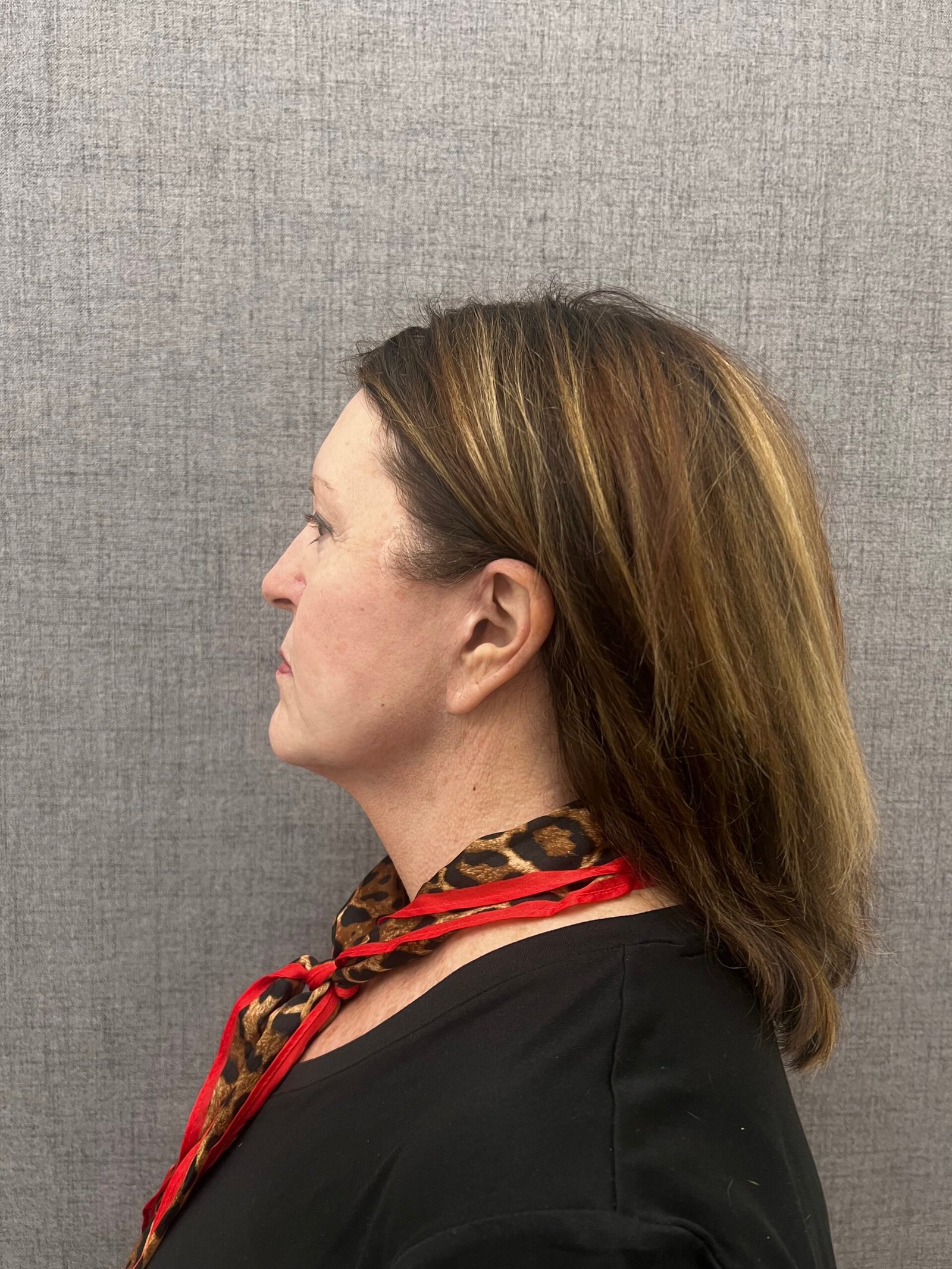Facelift Surgery Before