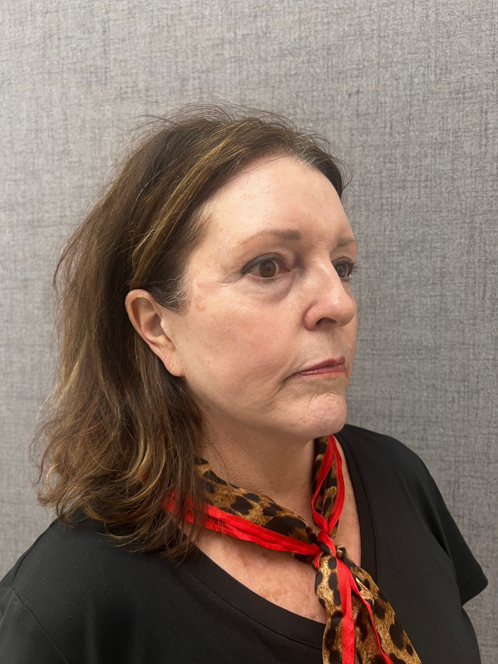 Facelift Surgery Before