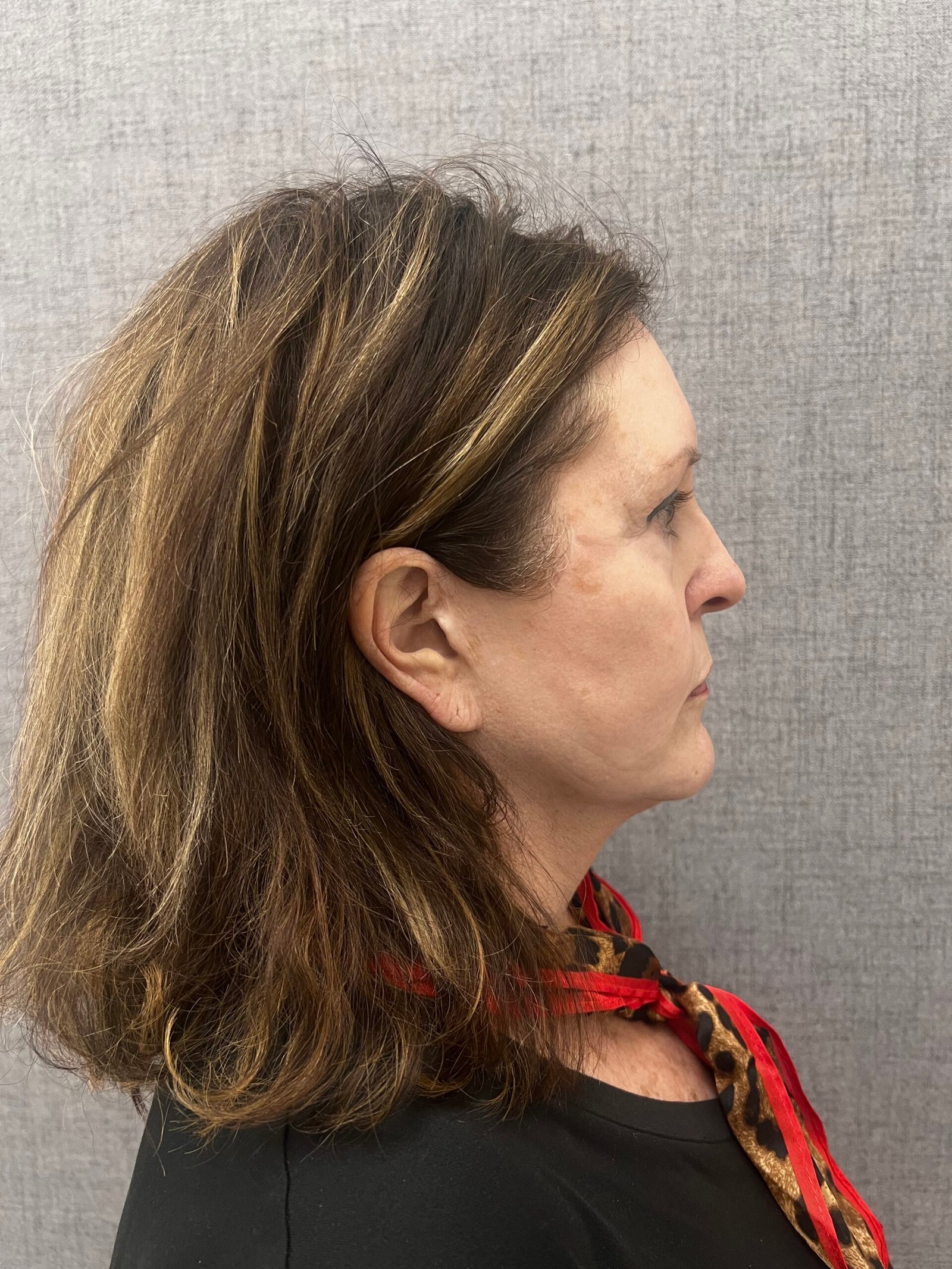 Facelift Surgery Before