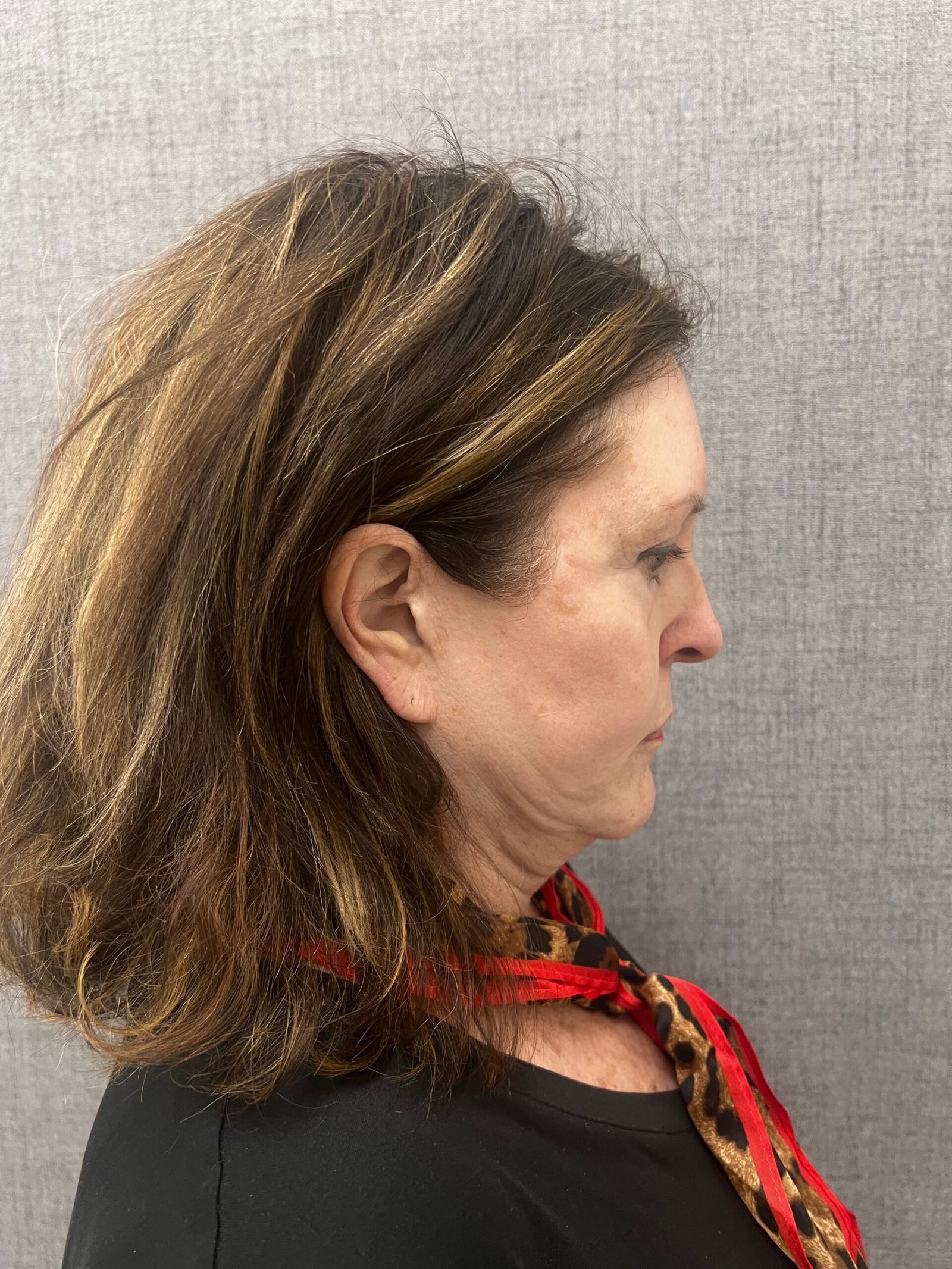 Facelift Surgery Before
