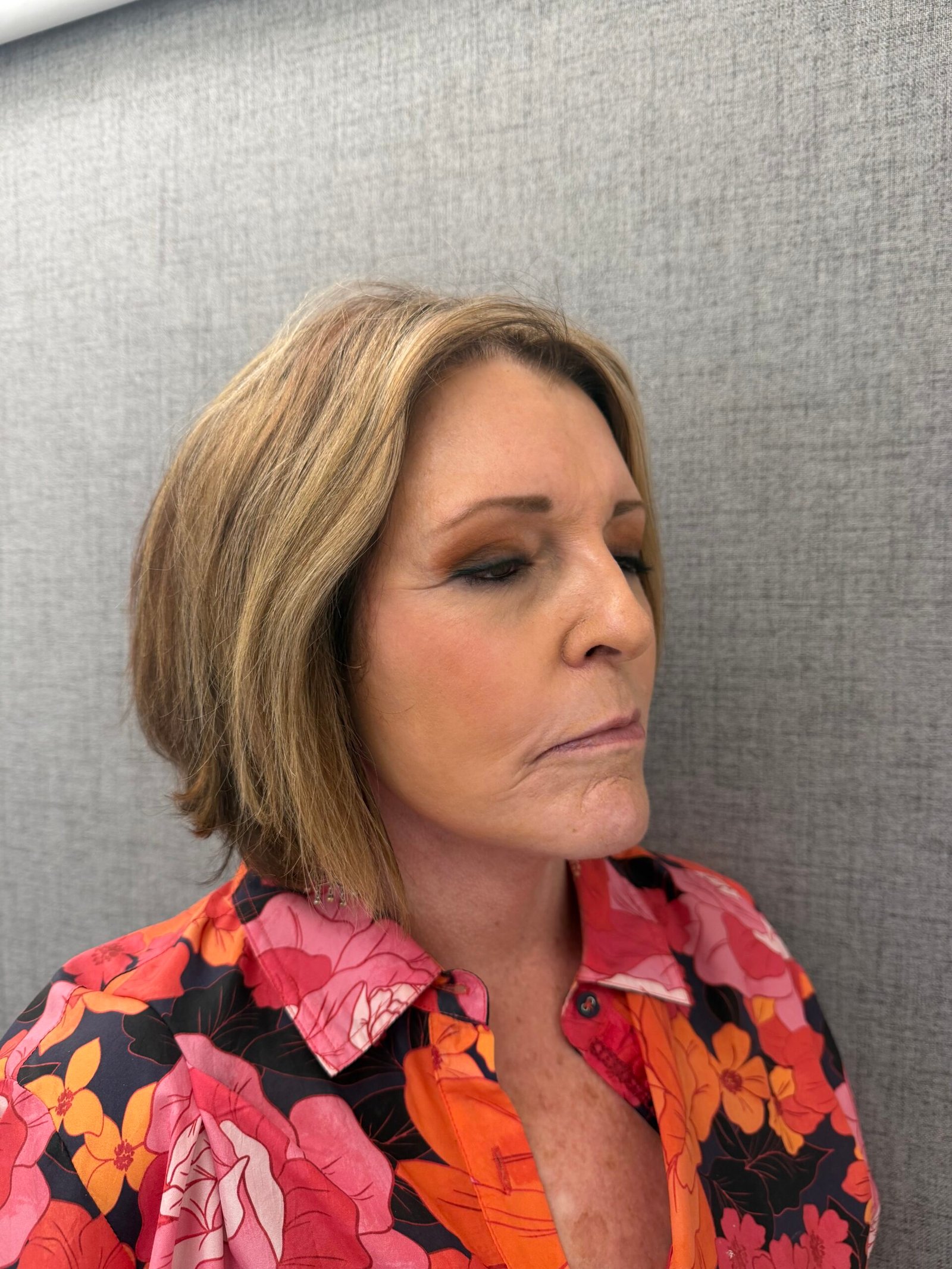 Facelift Surgery After