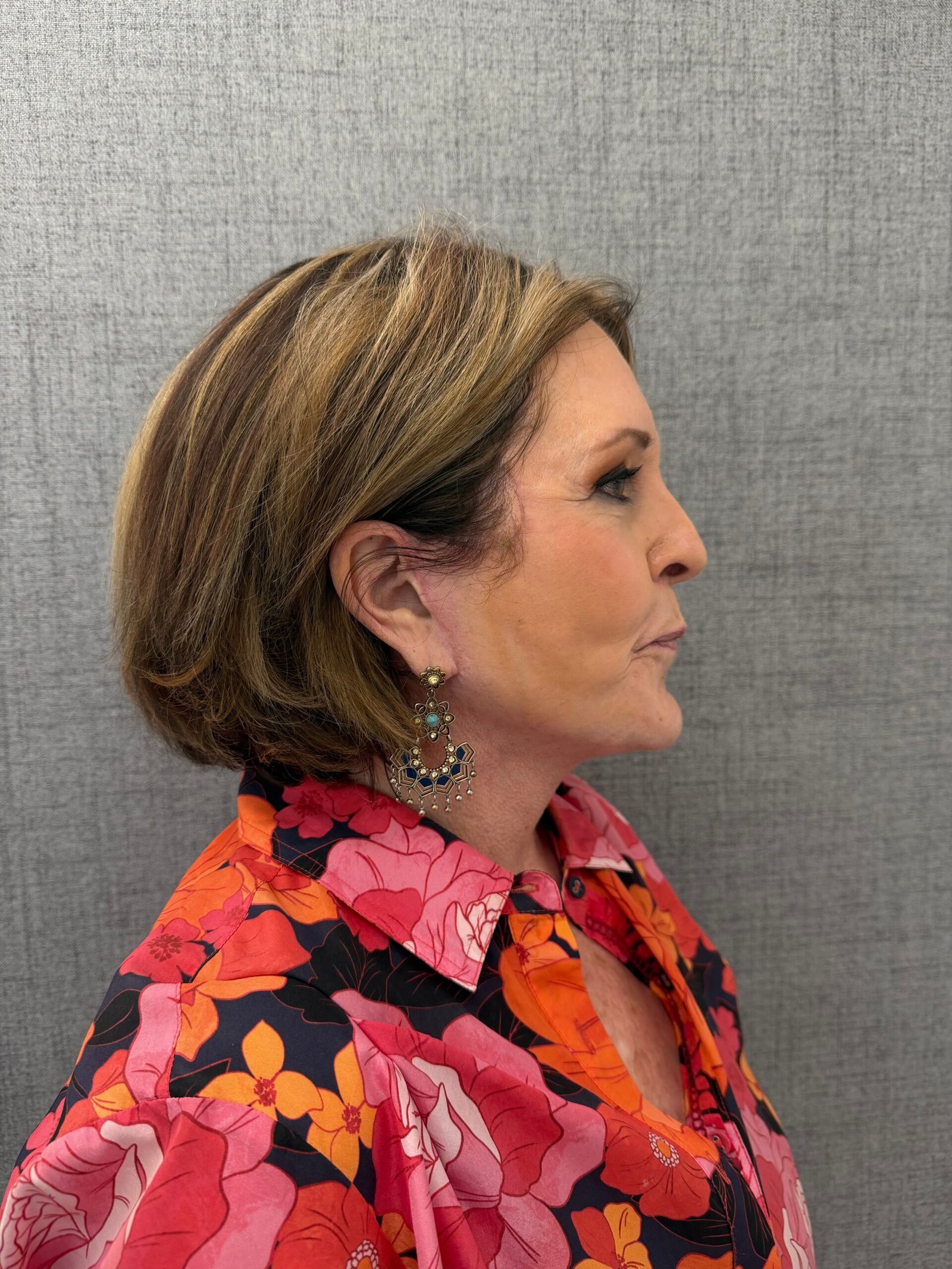 Facelift Surgery After