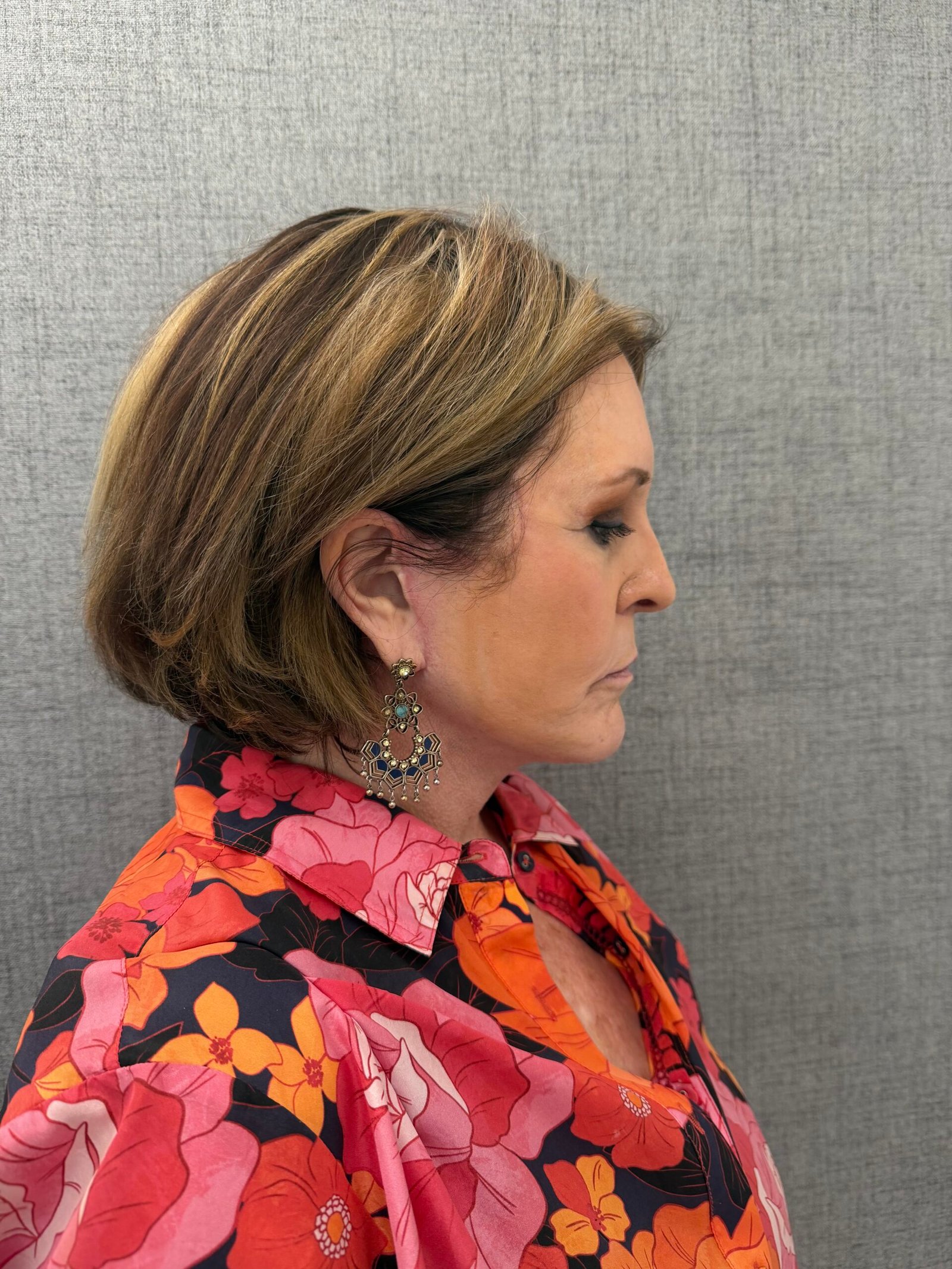 Facelift Surgery After