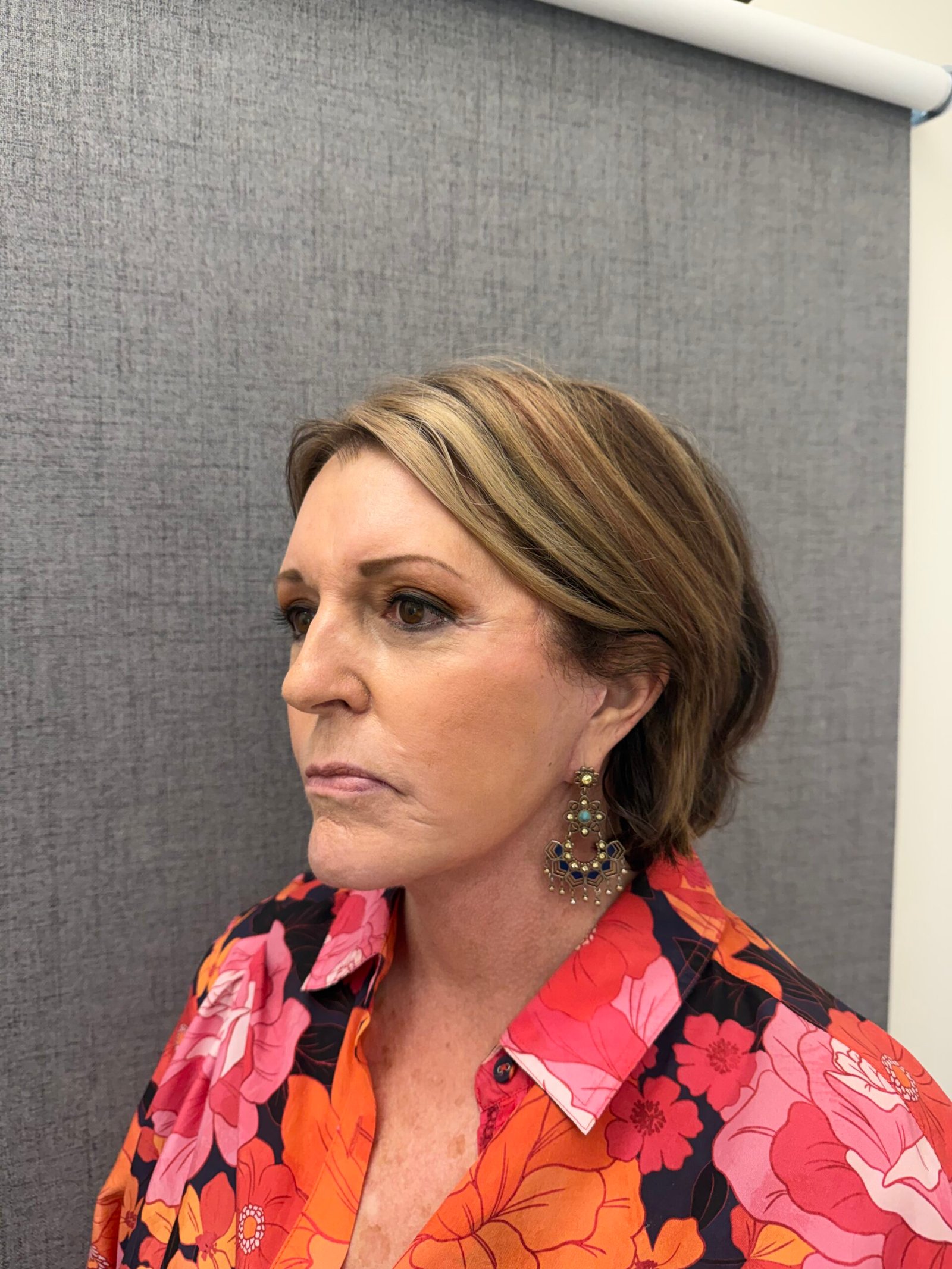 Facelift Surgery After