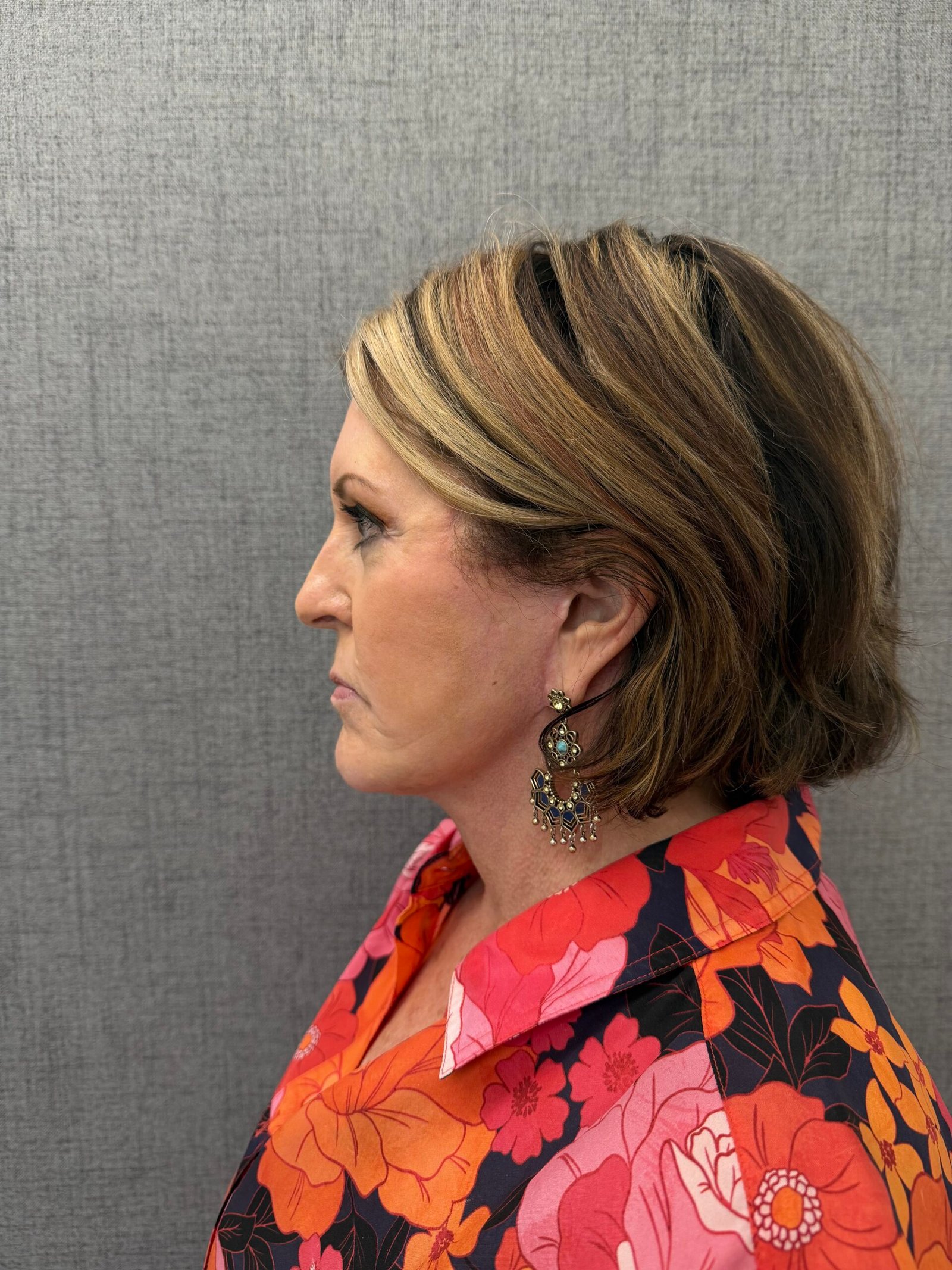 Facelift Surgery After