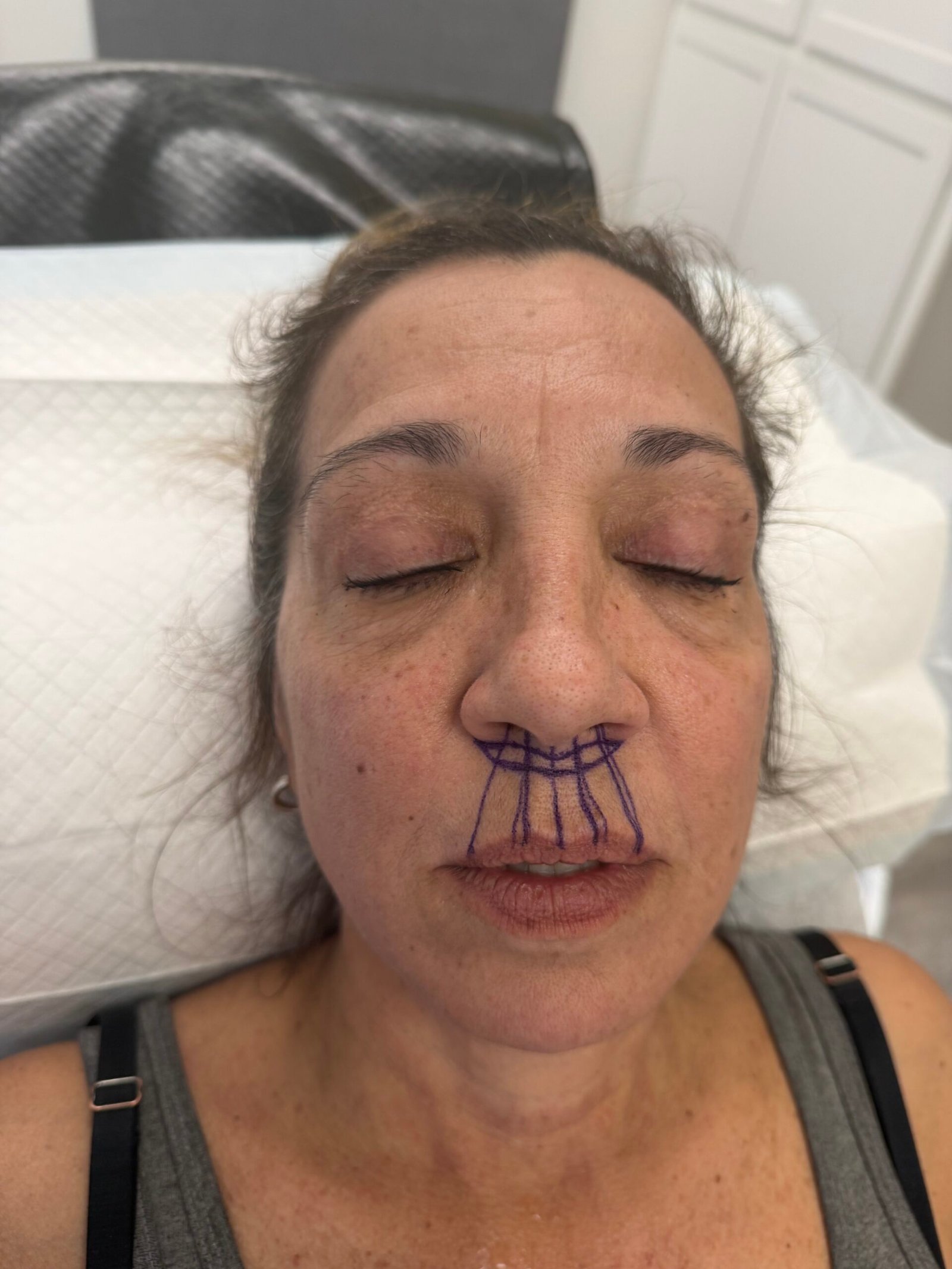 Lip Lift Before
