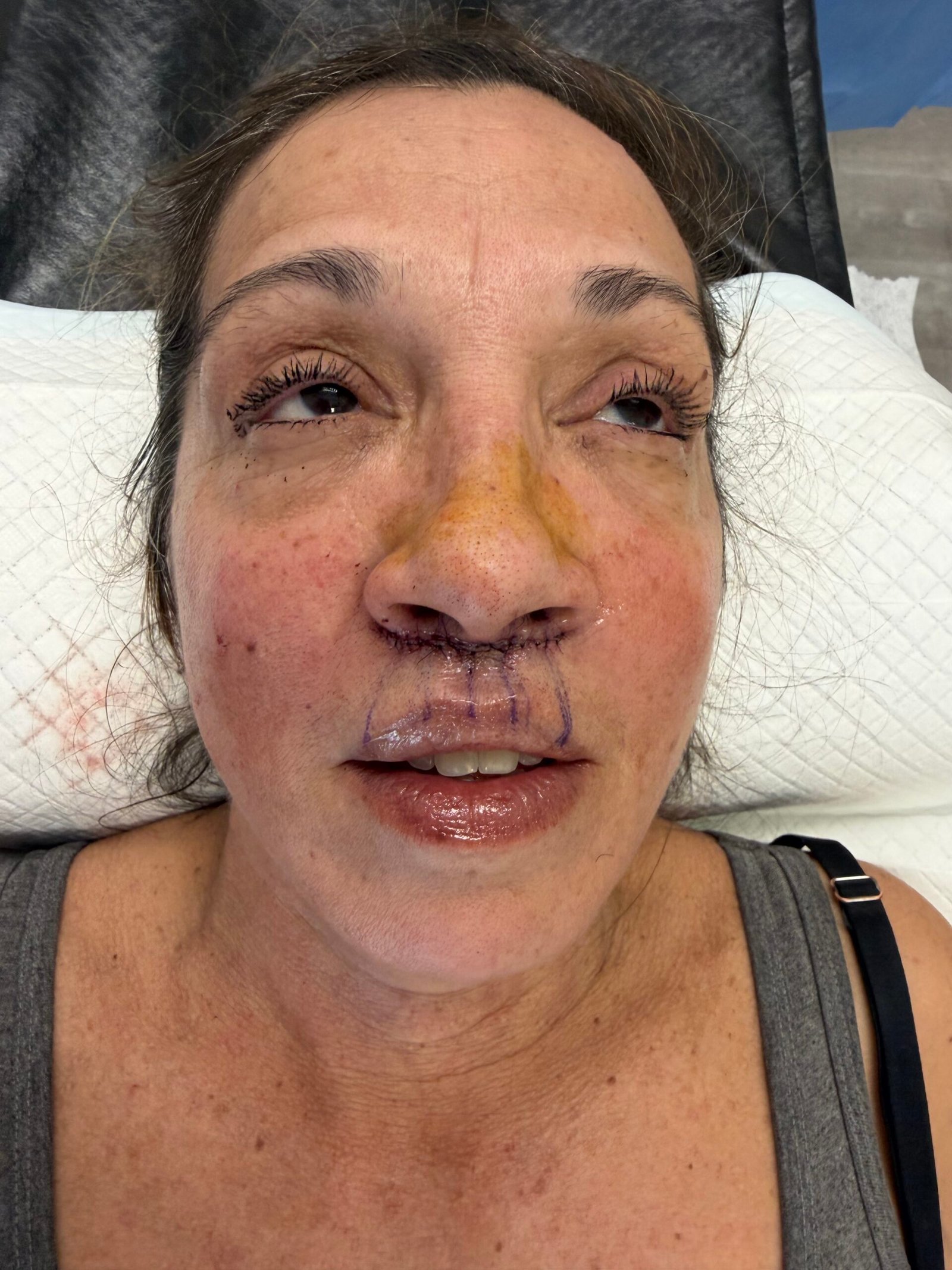 Lip Lift Before